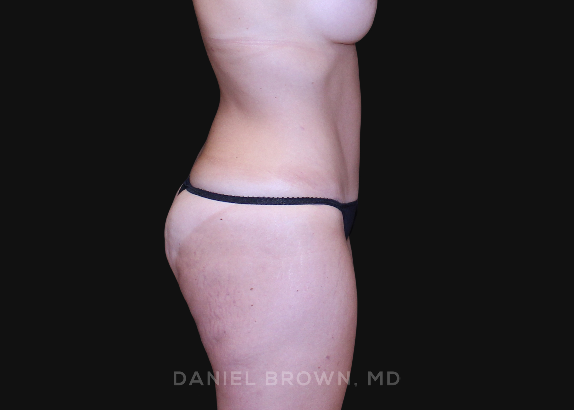 Tummy Tuck Patient Photo - Case 1213 - after view-4