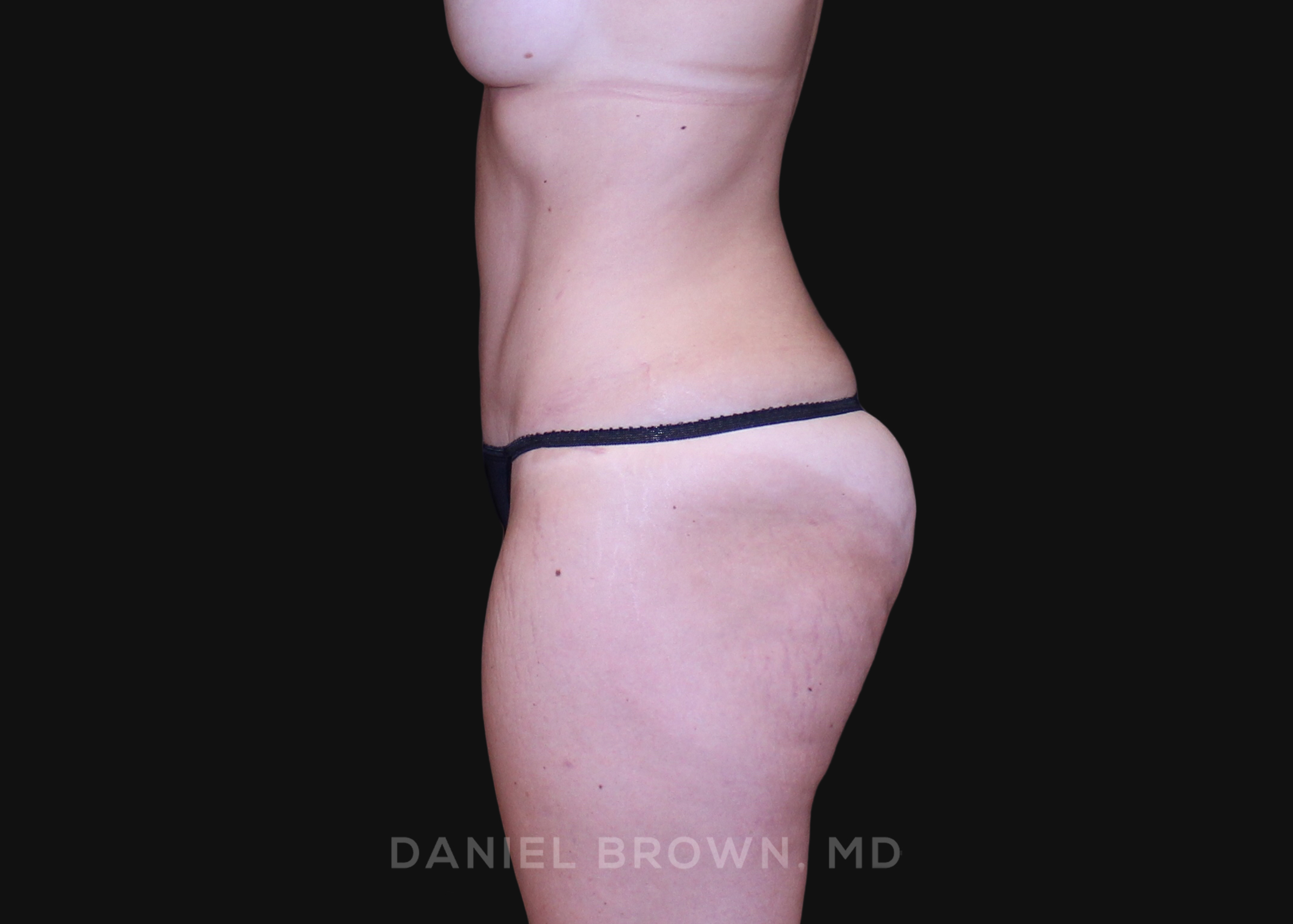 Tummy Tuck Patient Photo - Case 1213 - after view