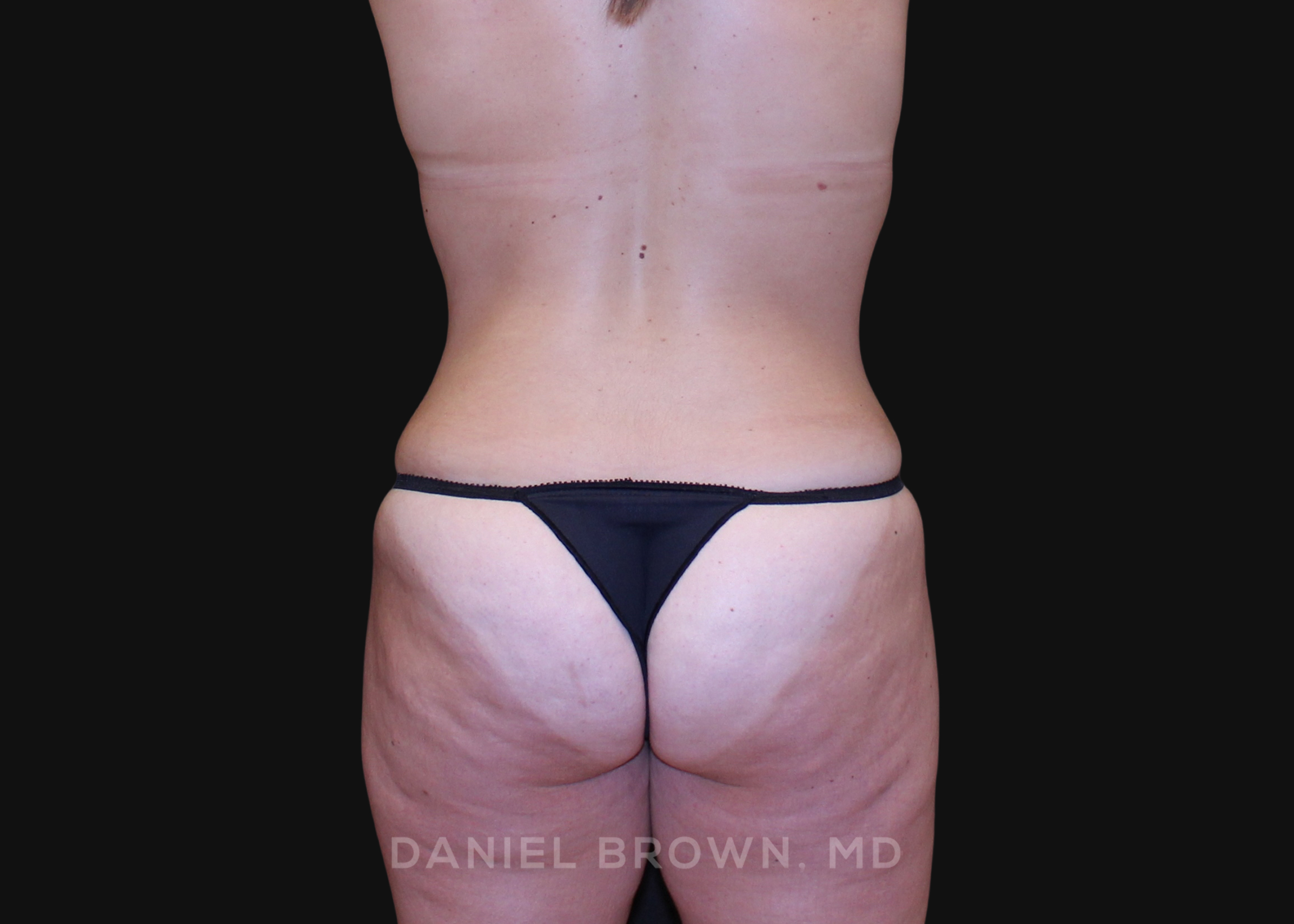 Tummy Tuck Patient Photo - Case 1213 - after view