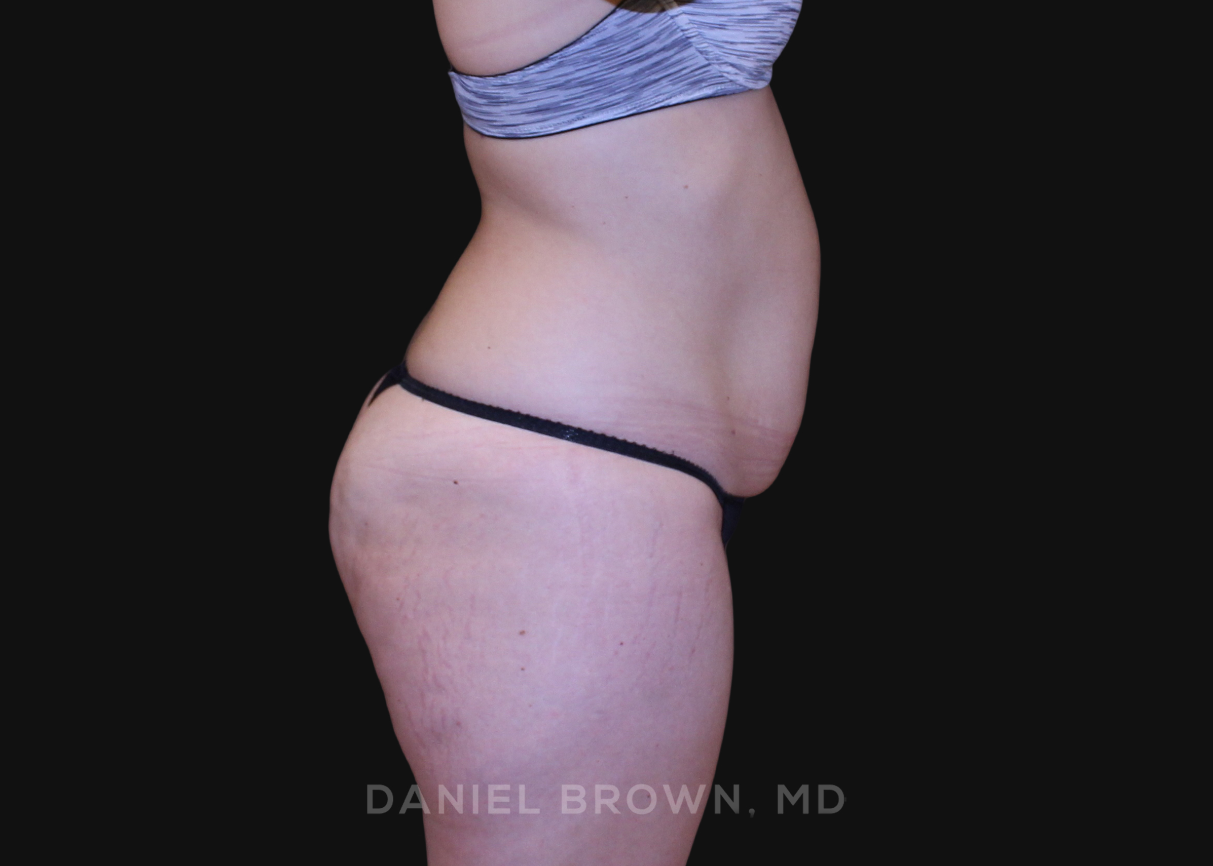 Tummy Tuck Patient Photo - Case 1213 - before view-