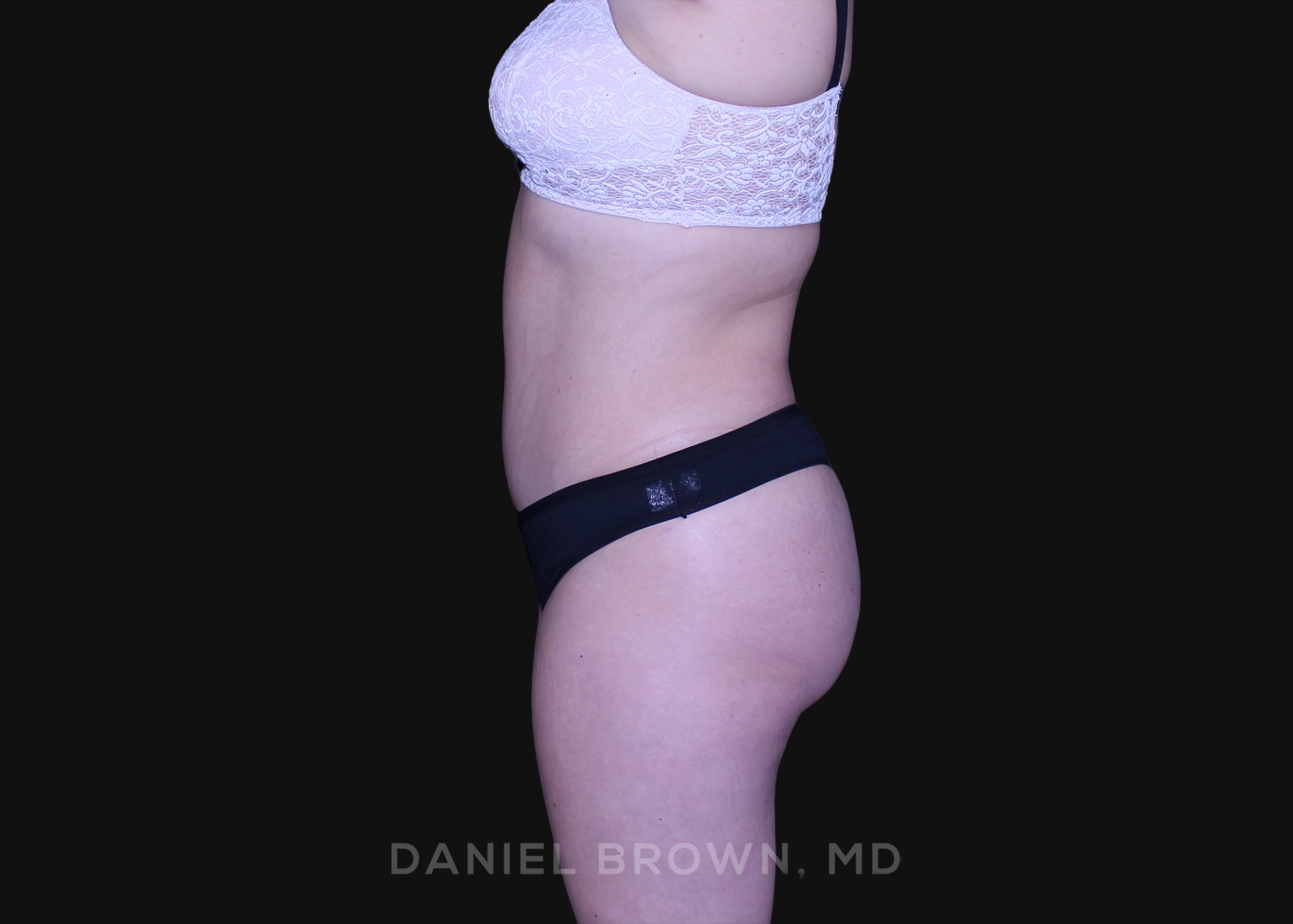Tummy Tuck Patient Photo - Case 1226 - after view