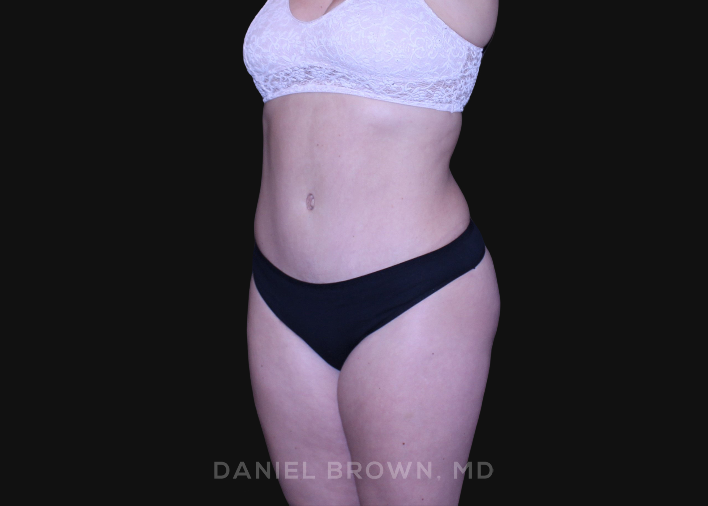 Tummy Tuck Patient Photo - Case 1226 - after view-1