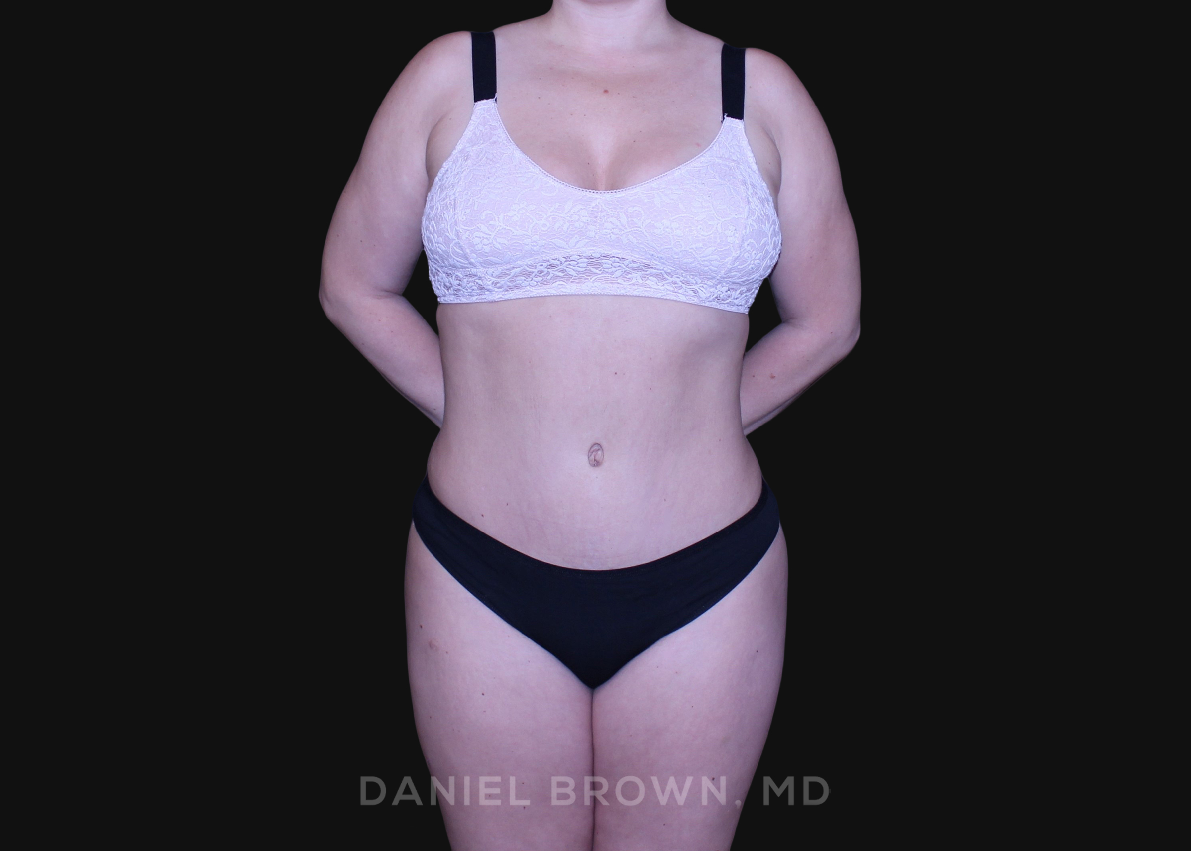 Tummy Tuck Patient Photo - Case 1226 - after view-0