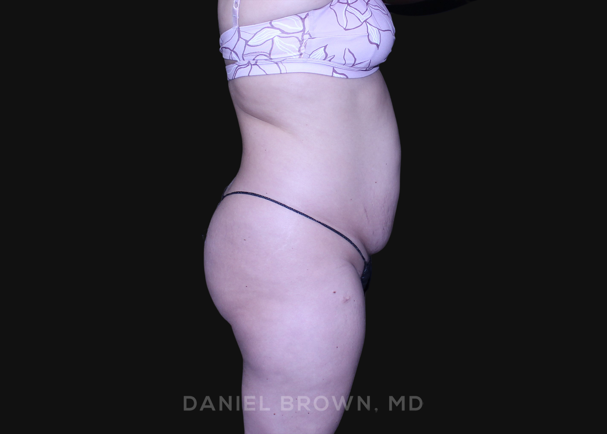 Tummy Tuck Patient Photo - Case 1226 - before view-