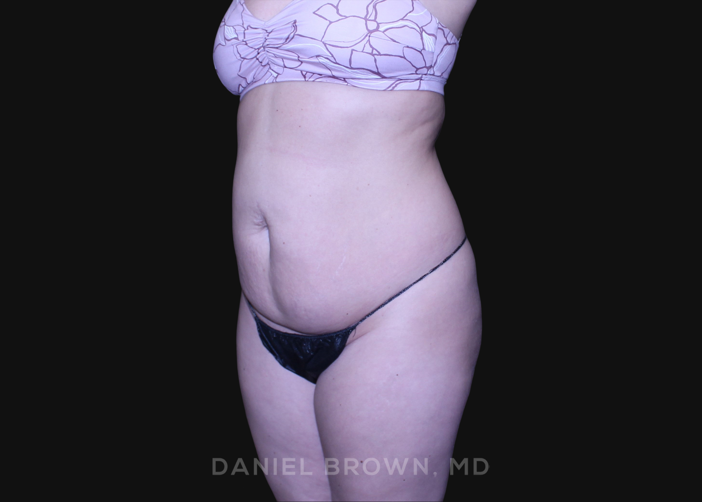 Tummy Tuck Patient Photo - Case 1226 - before view-