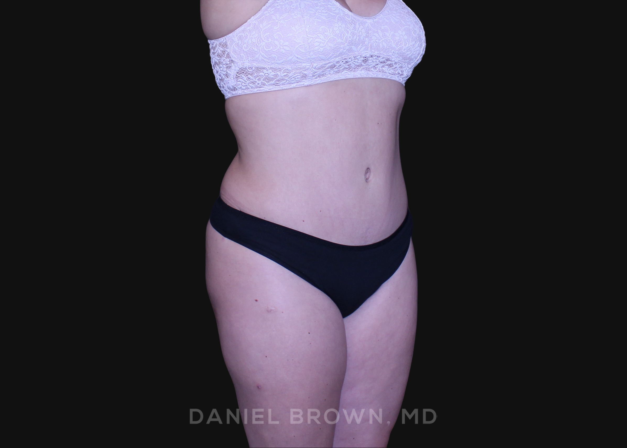 Tummy Tuck Patient Photo - Case 1226 - after view-2