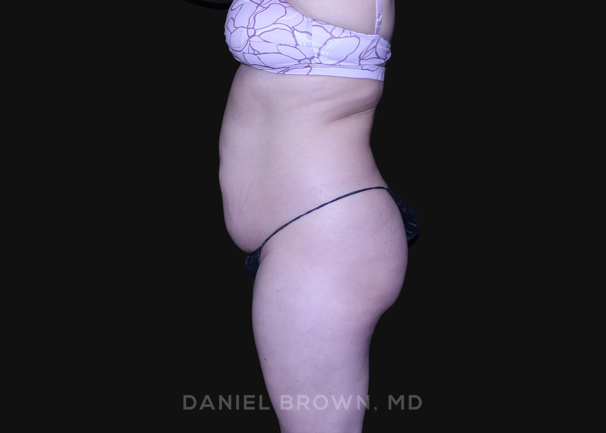 Tummy Tuck Patient Photo - Case 1226 - before view-3