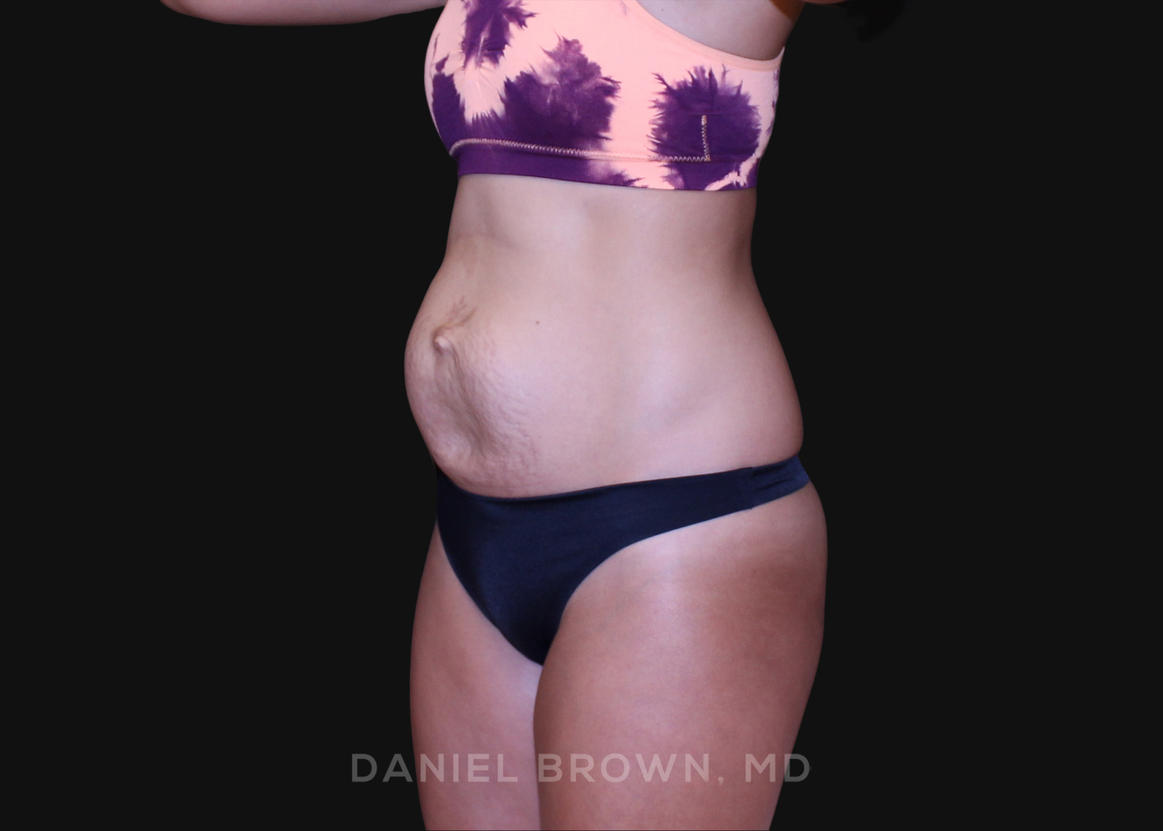 Tummy Tuck Patient Photo - Case 1239 - before view-1