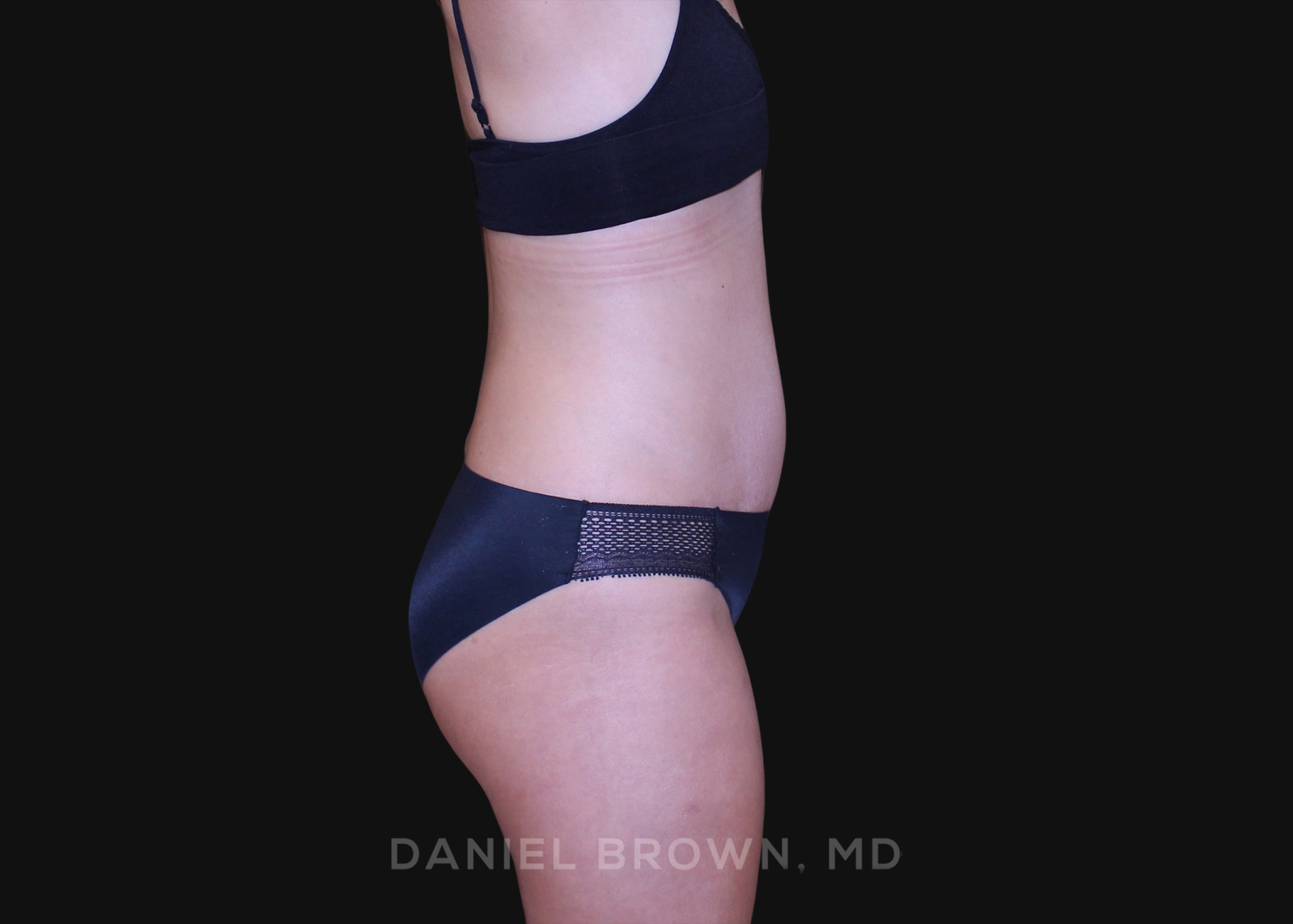 Tummy Tuck Patient Photo - Case 1239 - after view