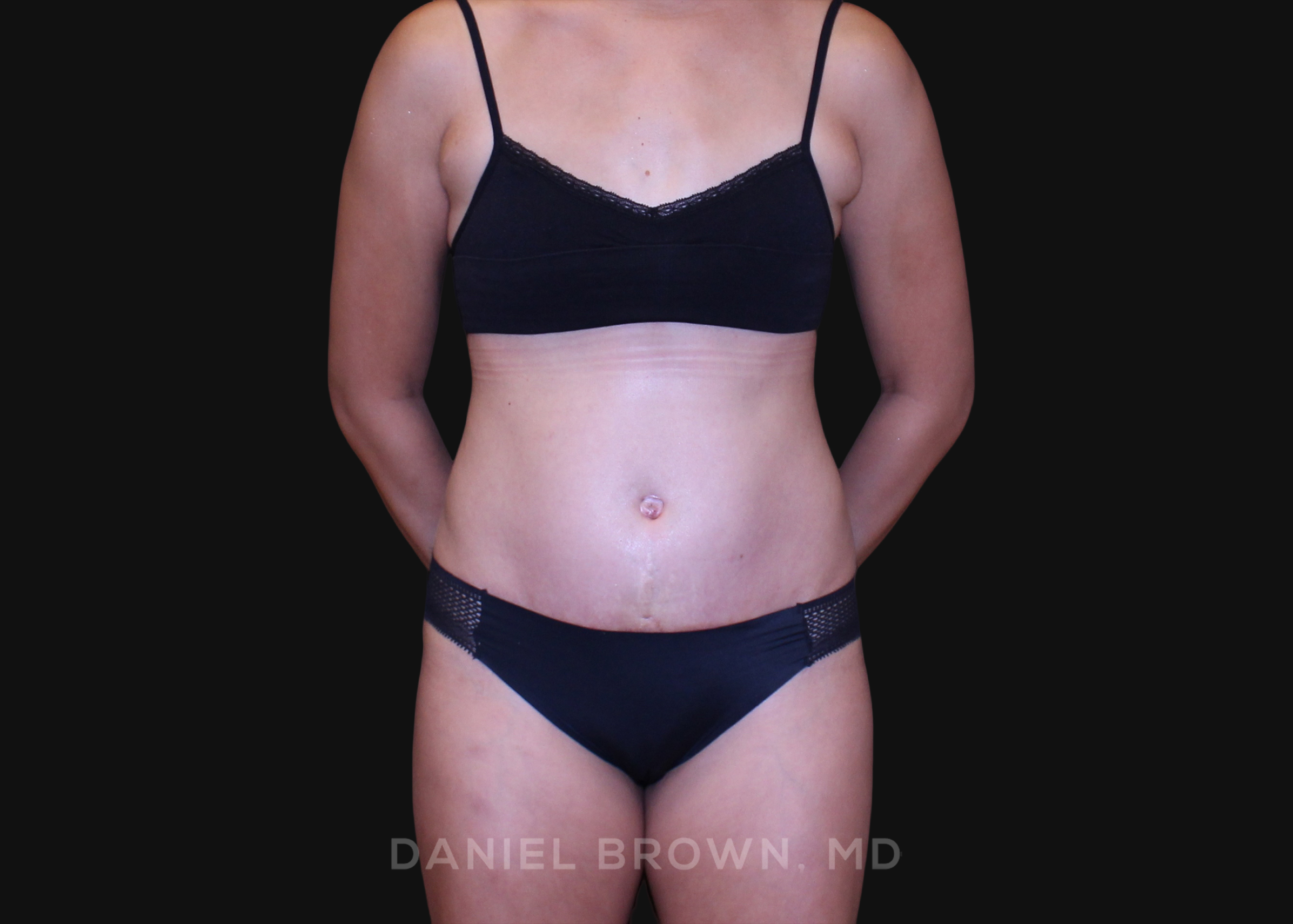 Tummy Tuck Patient Photo - Case 1239 - after view-0
