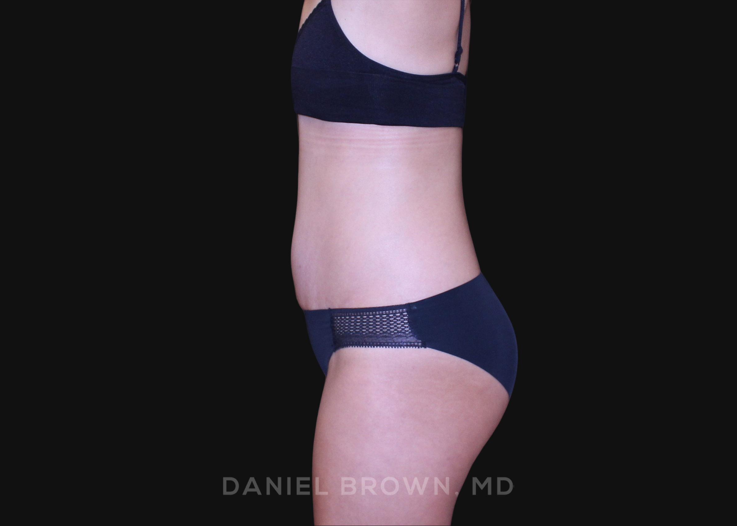 Tummy Tuck Patient Photo - Case 1239 - after view