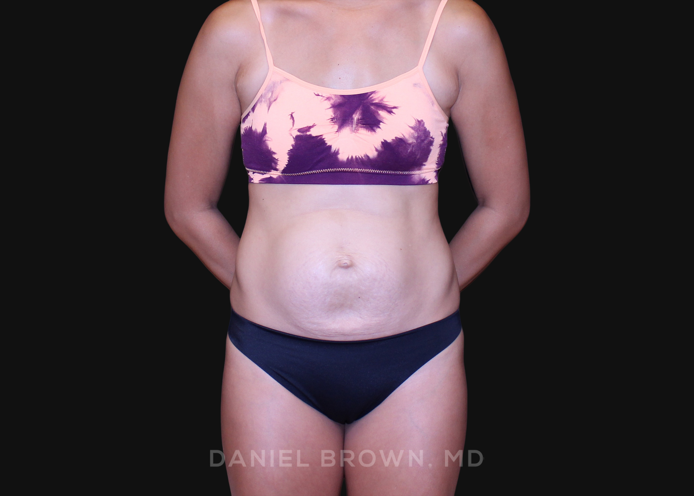 Tummy Tuck Patient Photo - Case 1239 - before view-0