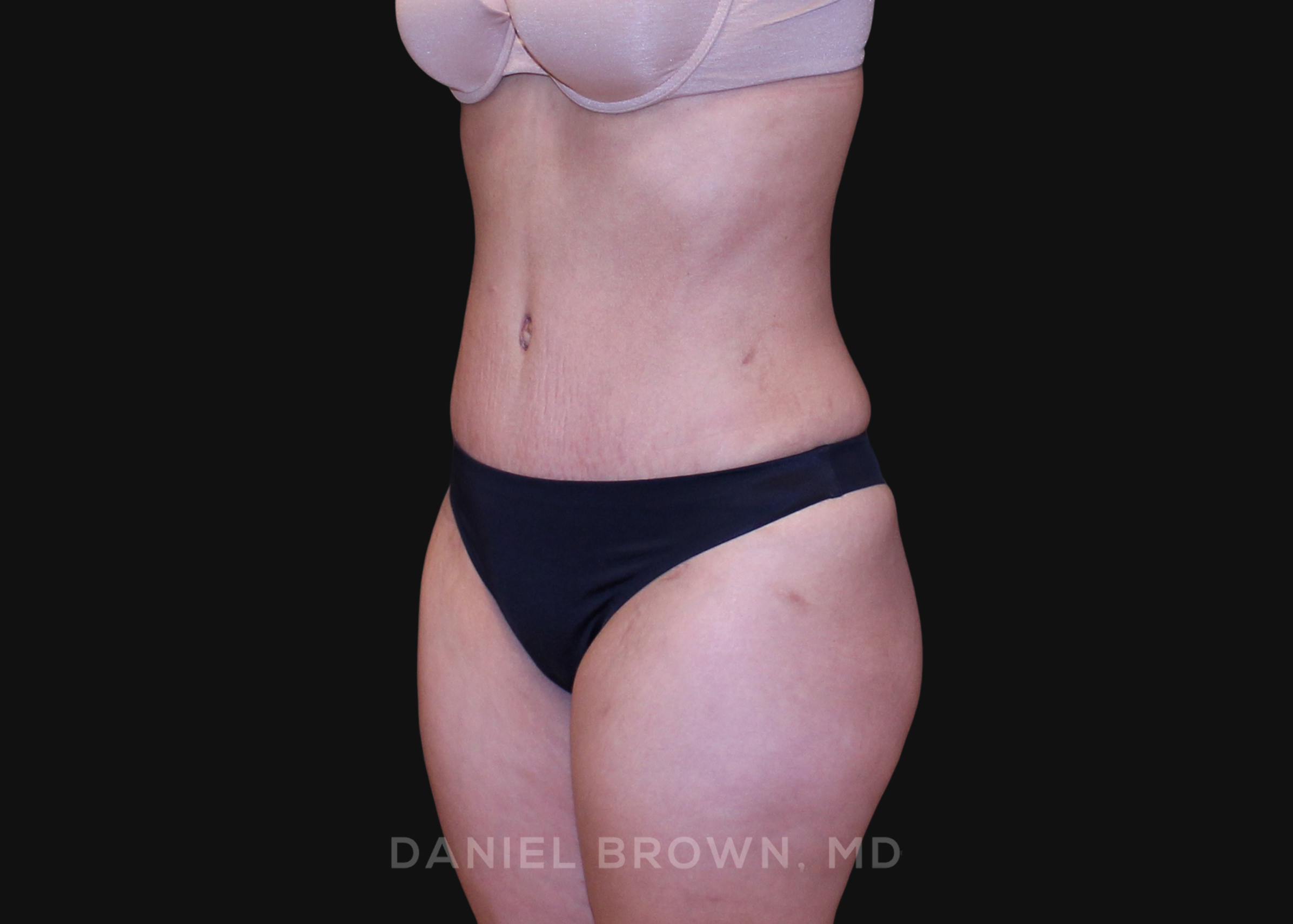 Tummy Tuck Patient Photo - Case 1252 - after view-1