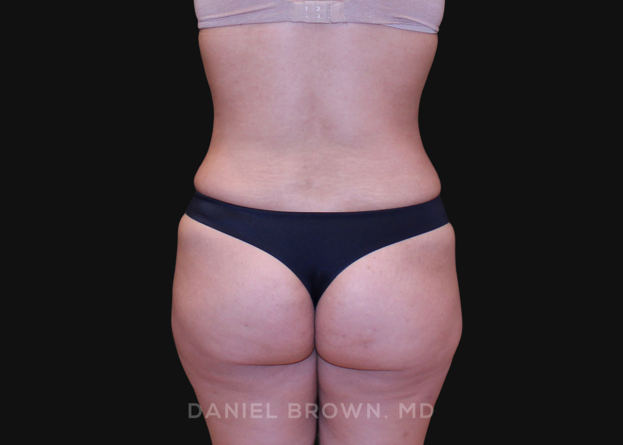 Tummy Tuck Patient Photo - Case 1252 - after view-5