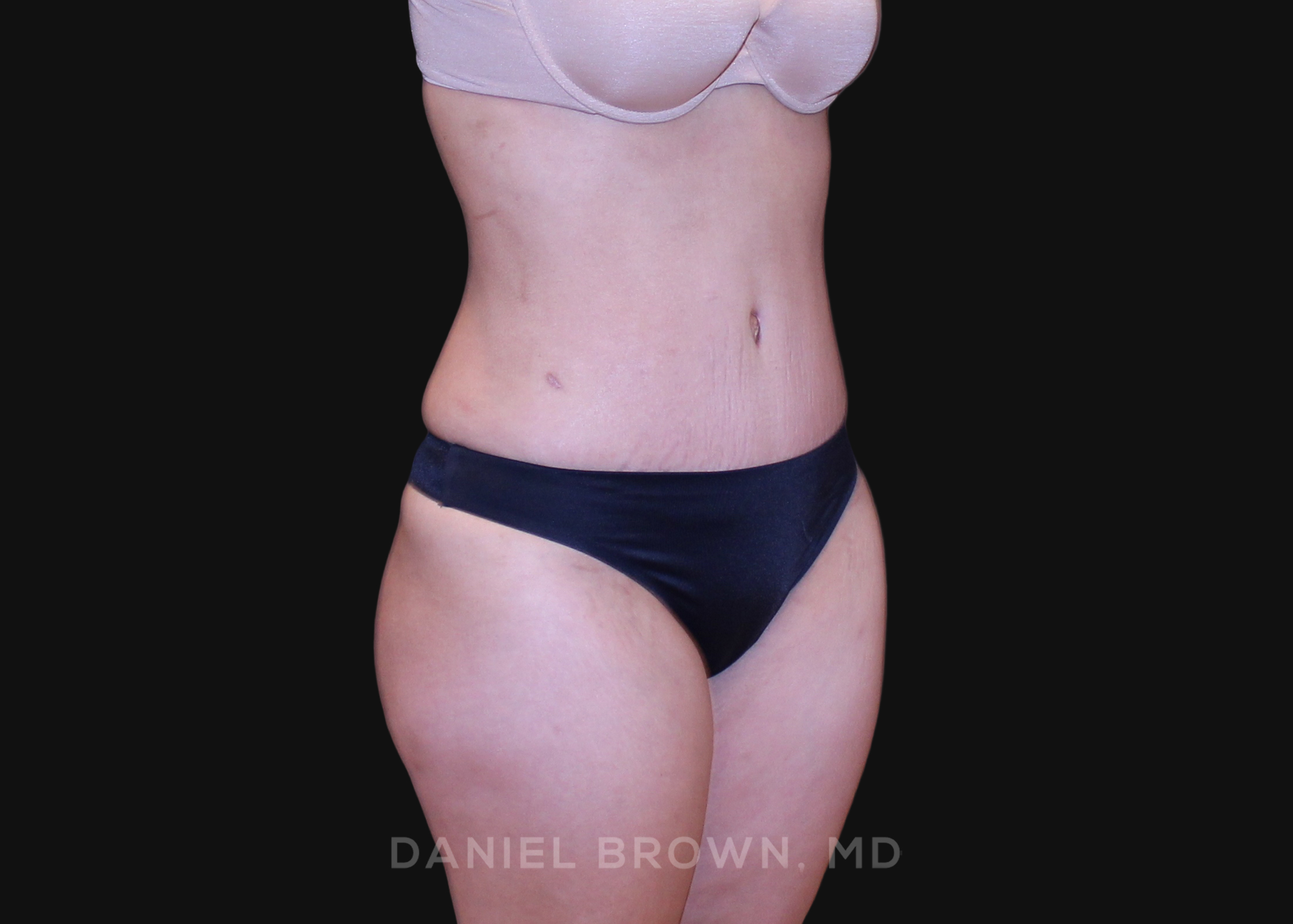 Tummy Tuck Patient Photo - Case 1252 - after view