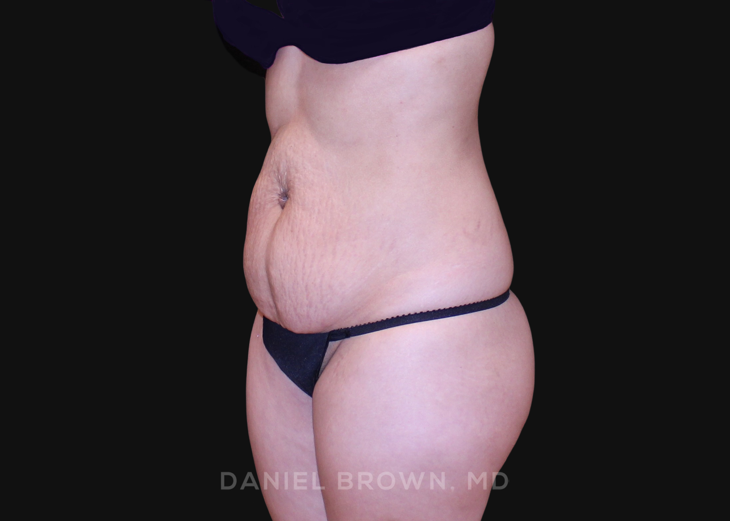 Tummy Tuck Patient Photo - Case 1252 - before view-1