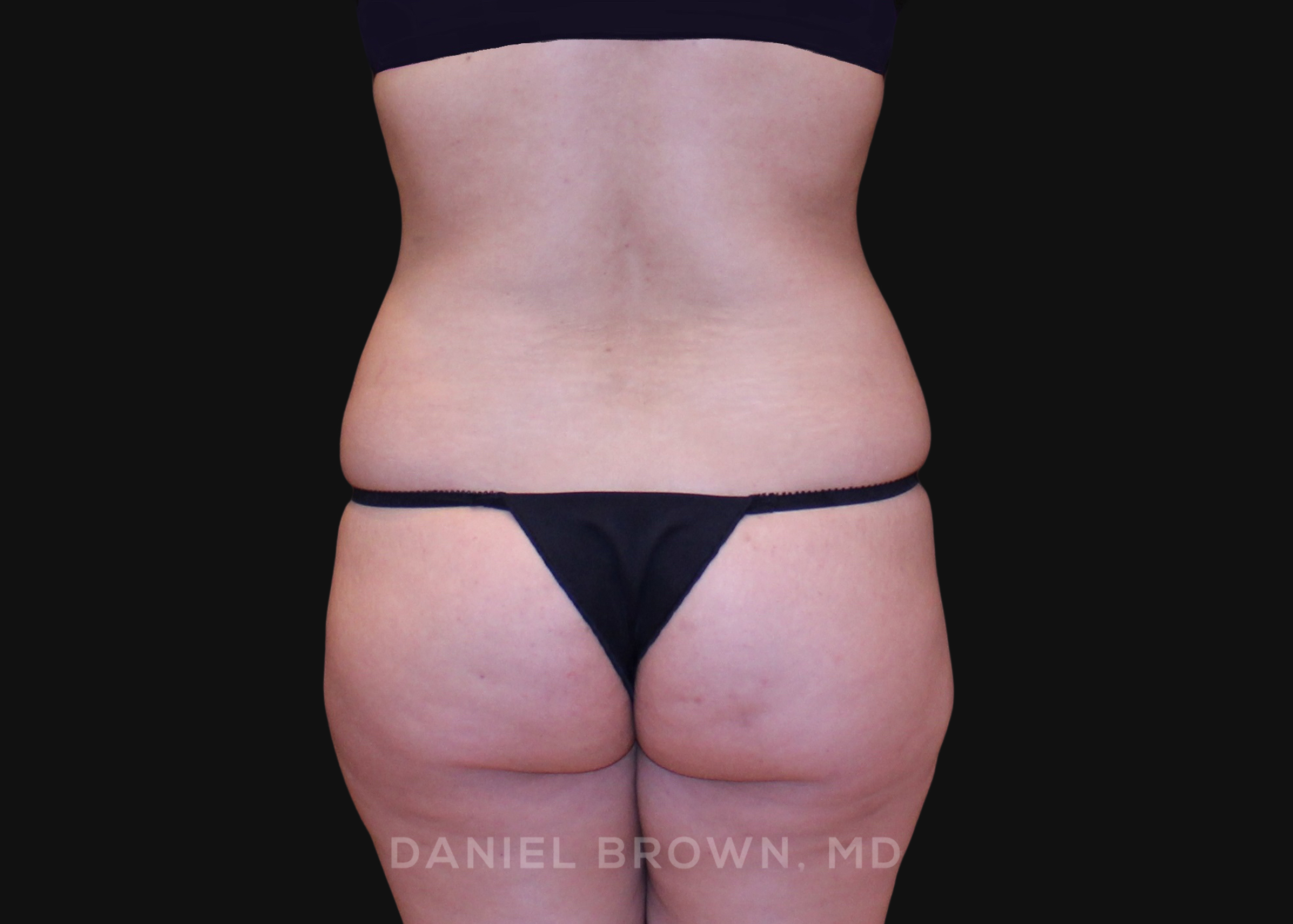 Tummy Tuck Patient Photo - Case 1252 - before view-