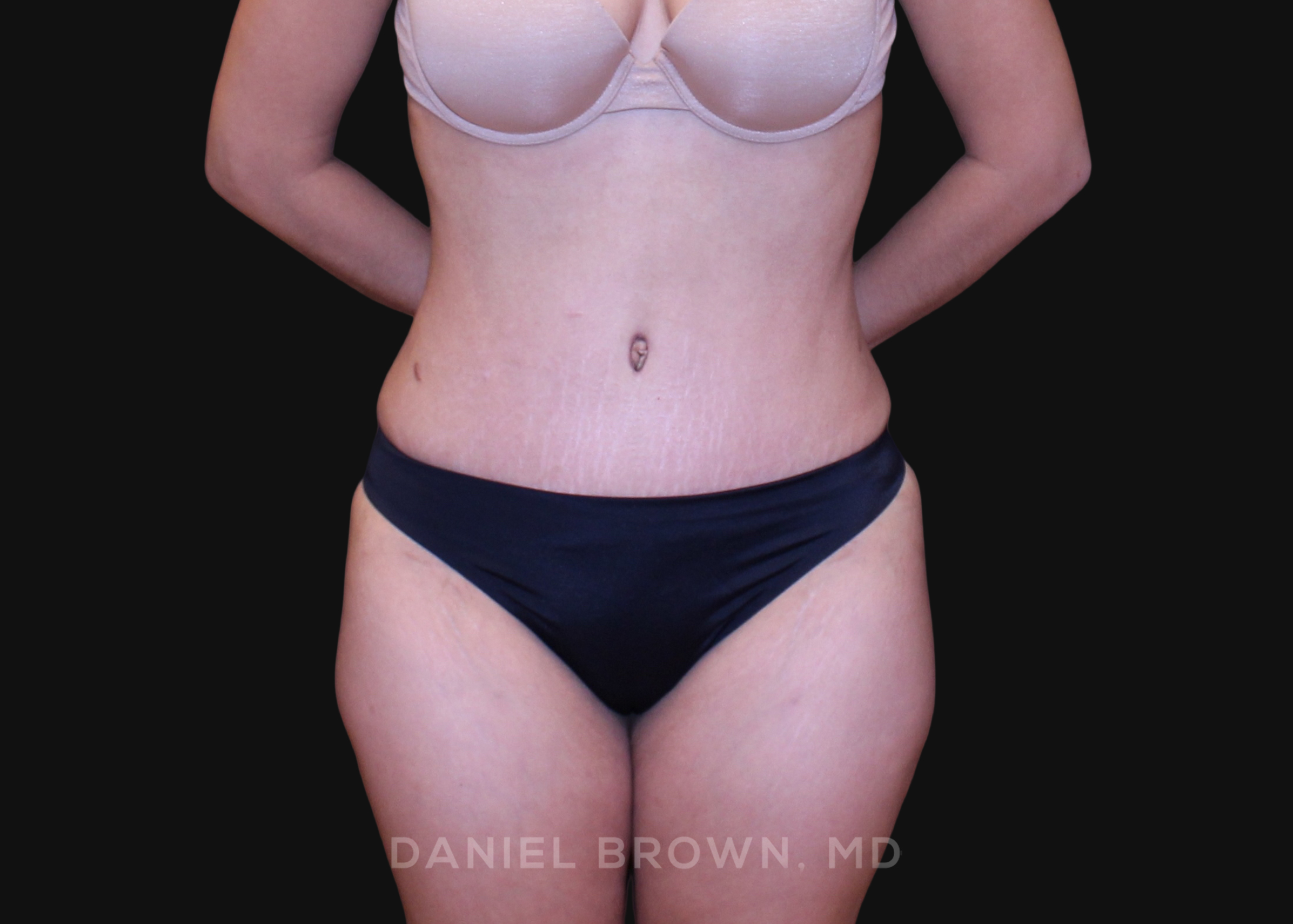 Tummy Tuck Patient Photo - Case 1252 - after view