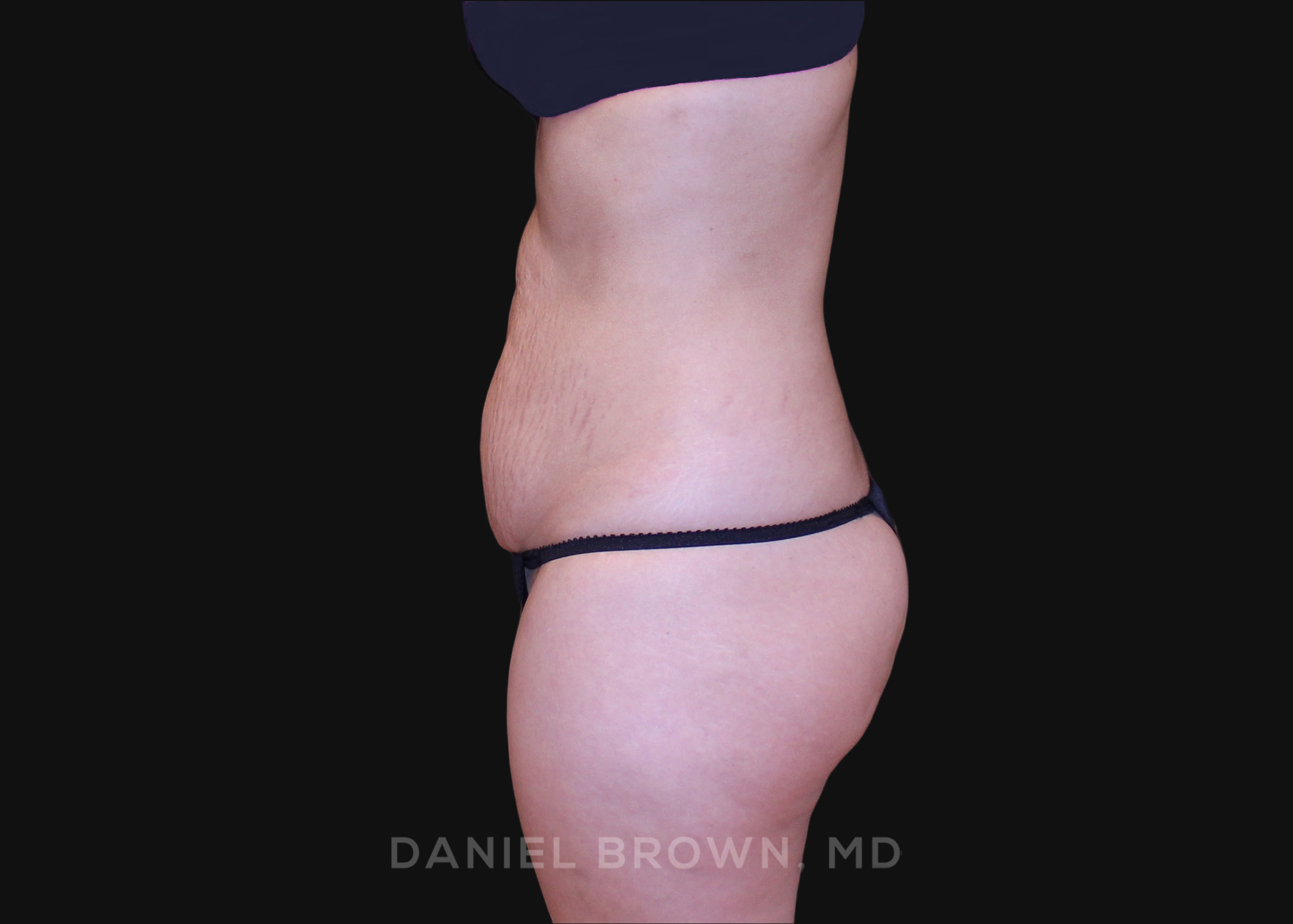 Tummy Tuck Patient Photo - Case 1252 - before view-3