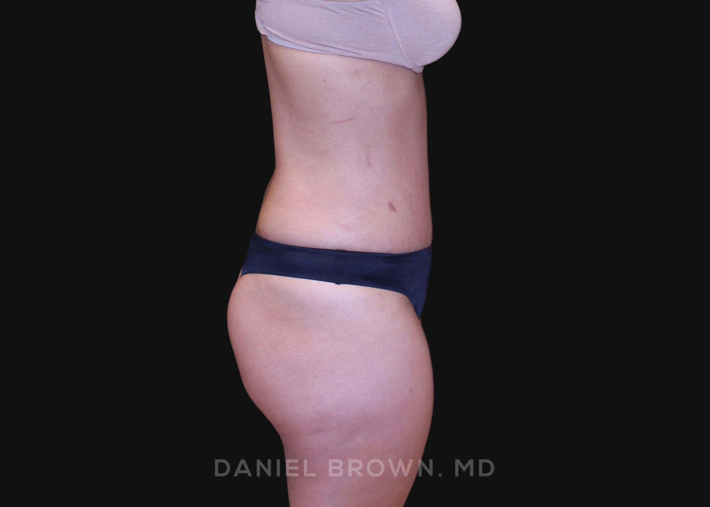 Tummy Tuck Patient Photo - Case 1252 - after view-4