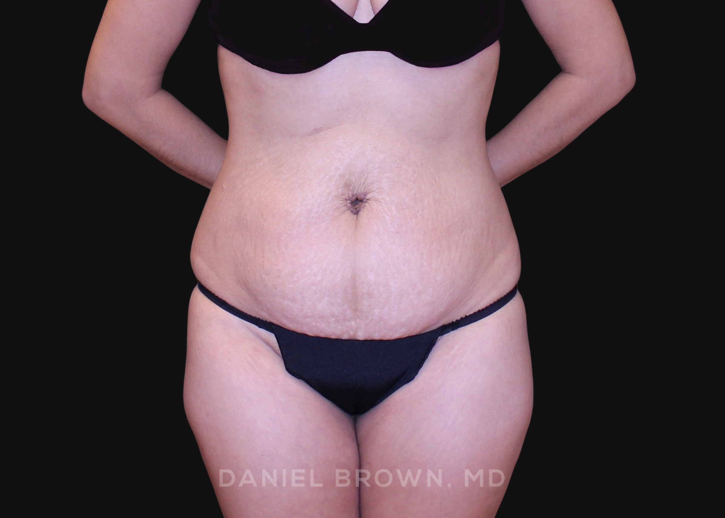 Tummy Tuck Patient Photo - Case 1252 - before view-0