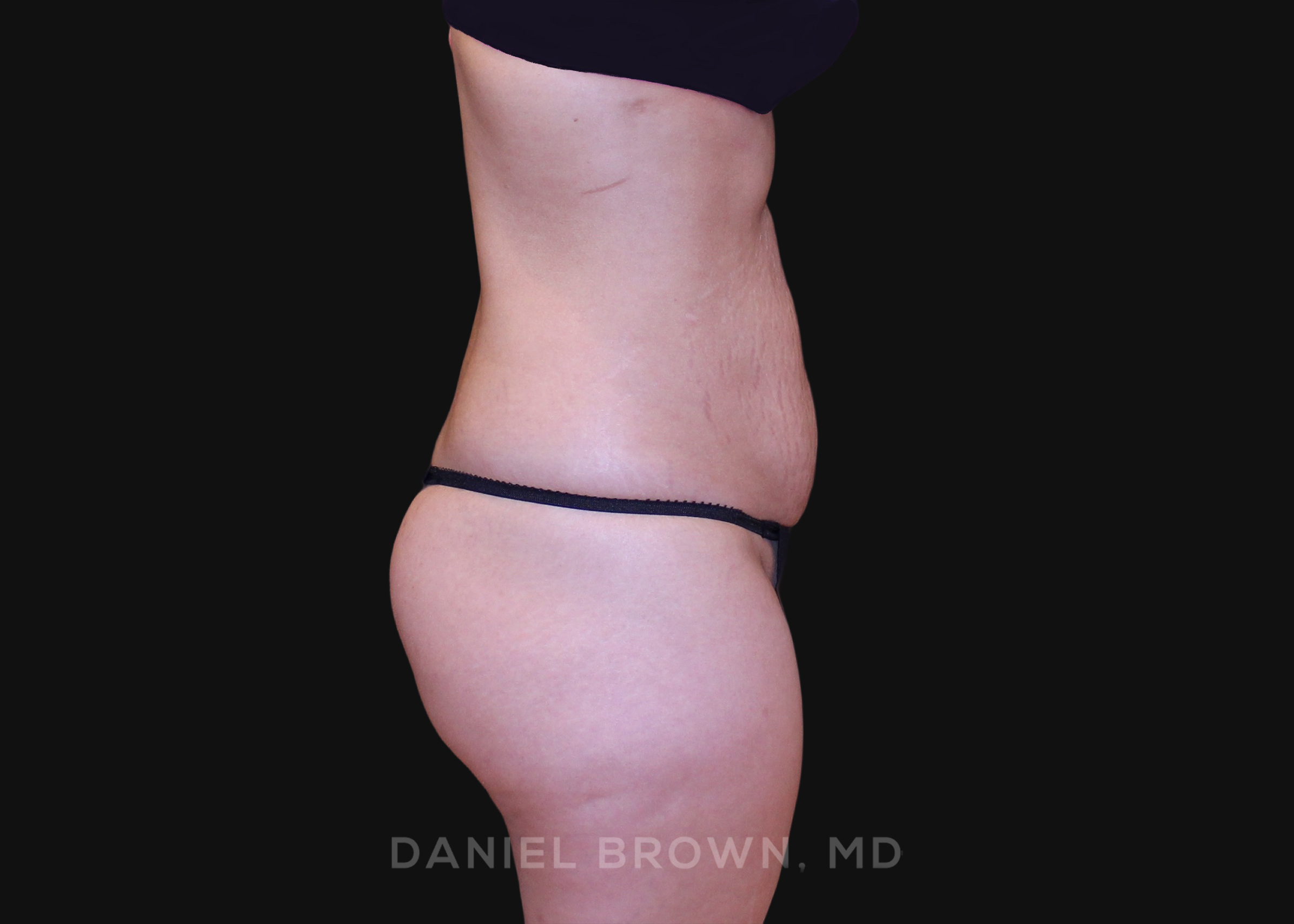 Tummy Tuck Patient Photo - Case 1252 - before view-4