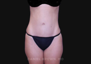 Tummy Tuck - Case 1265 - After