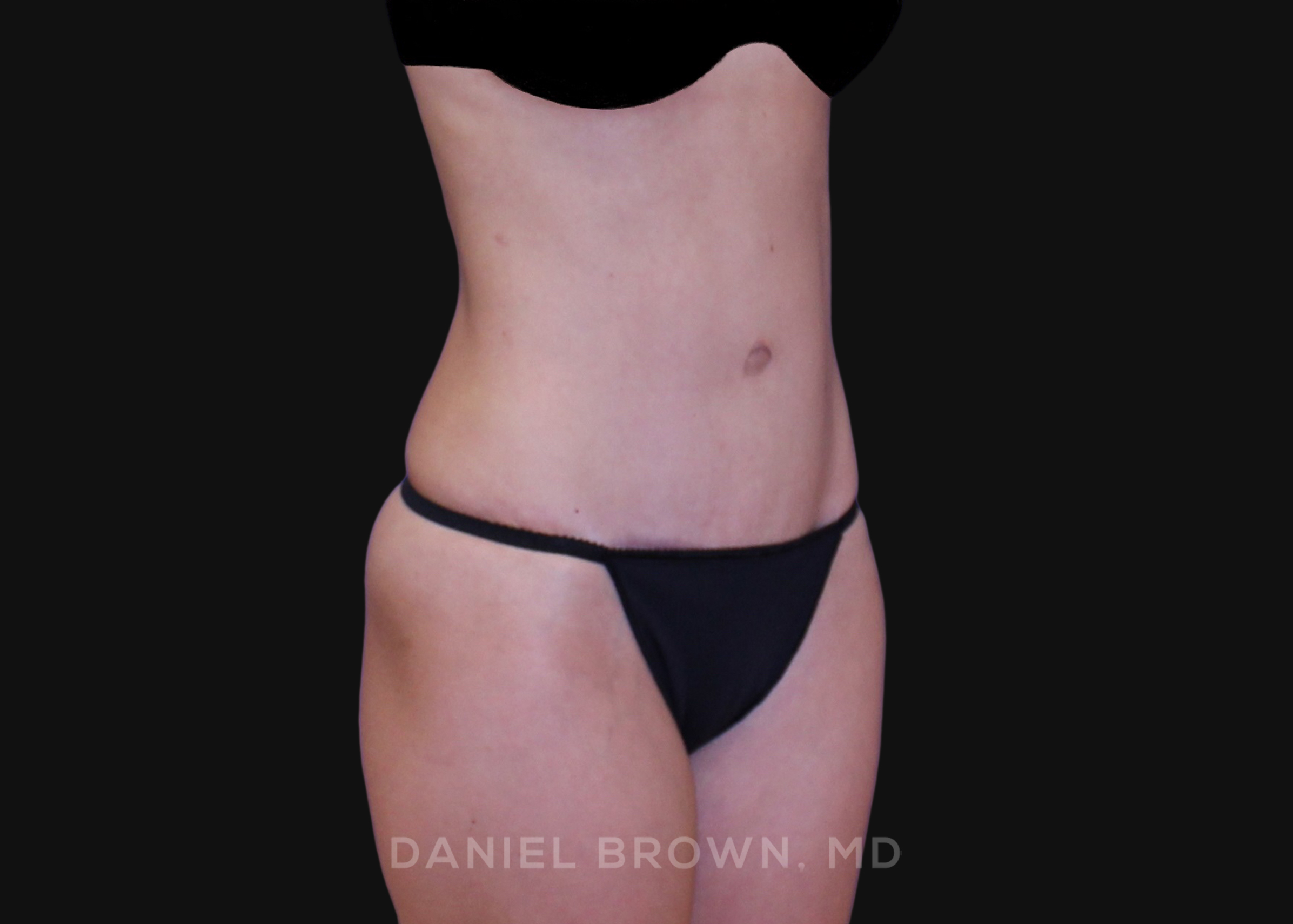 Tummy Tuck Patient Photo - Case 1265 - after view