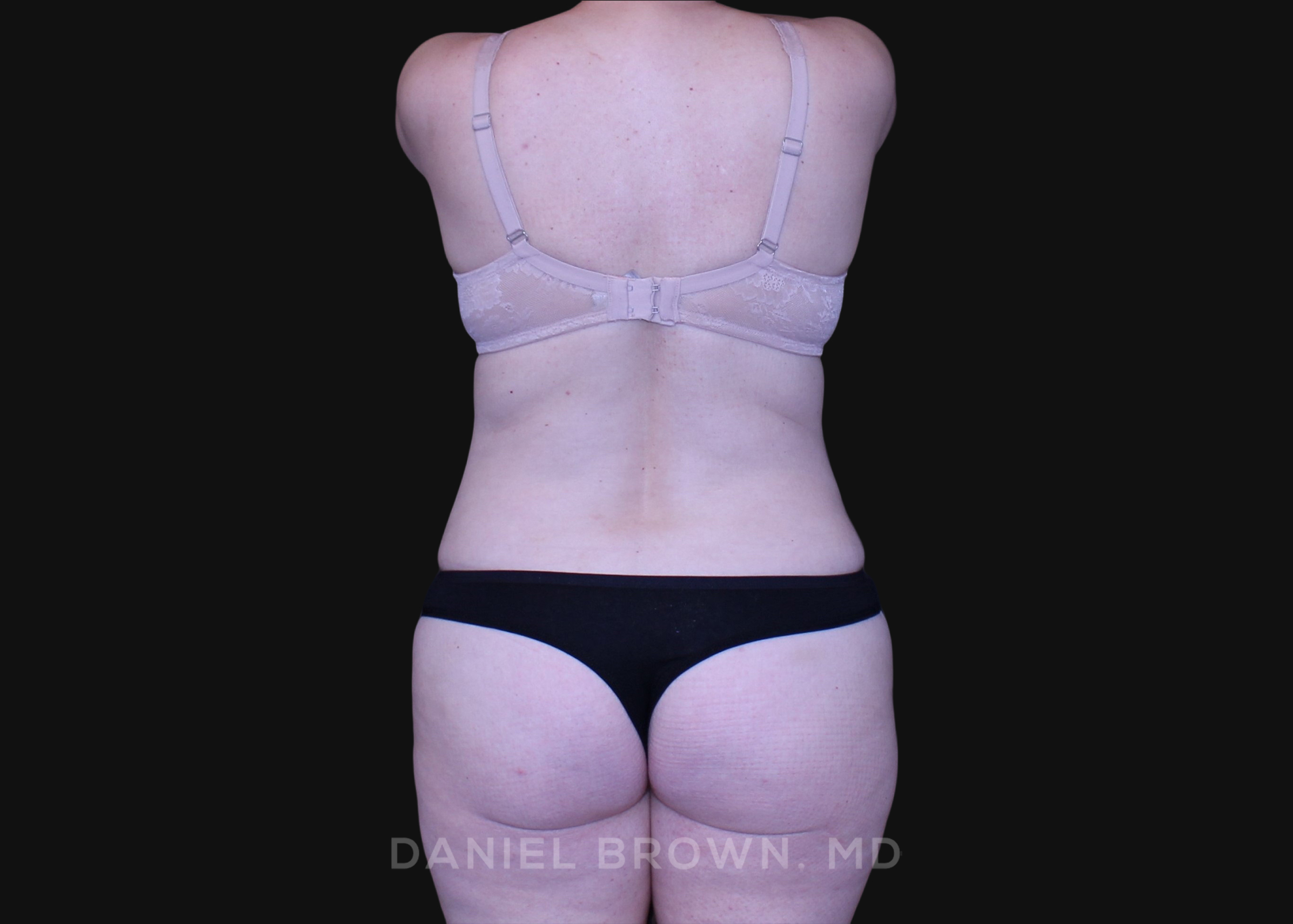 Tummy Tuck Patient Photo - Case 1278 - after view