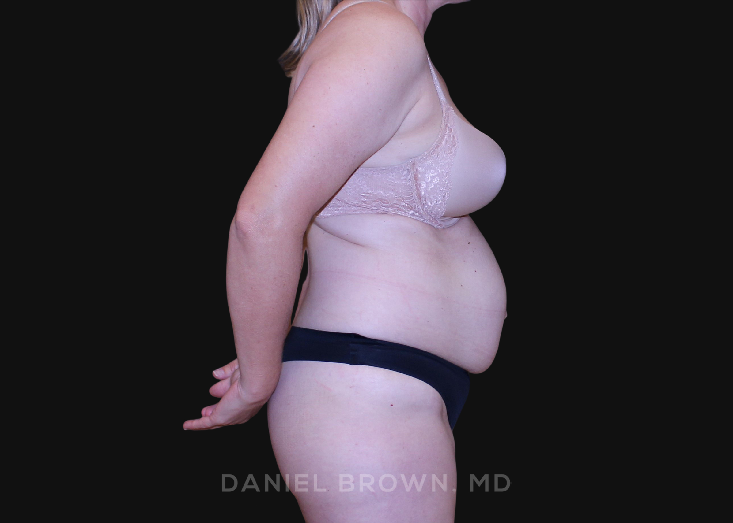 Tummy Tuck Patient Photo - Case 1278 - before view-4