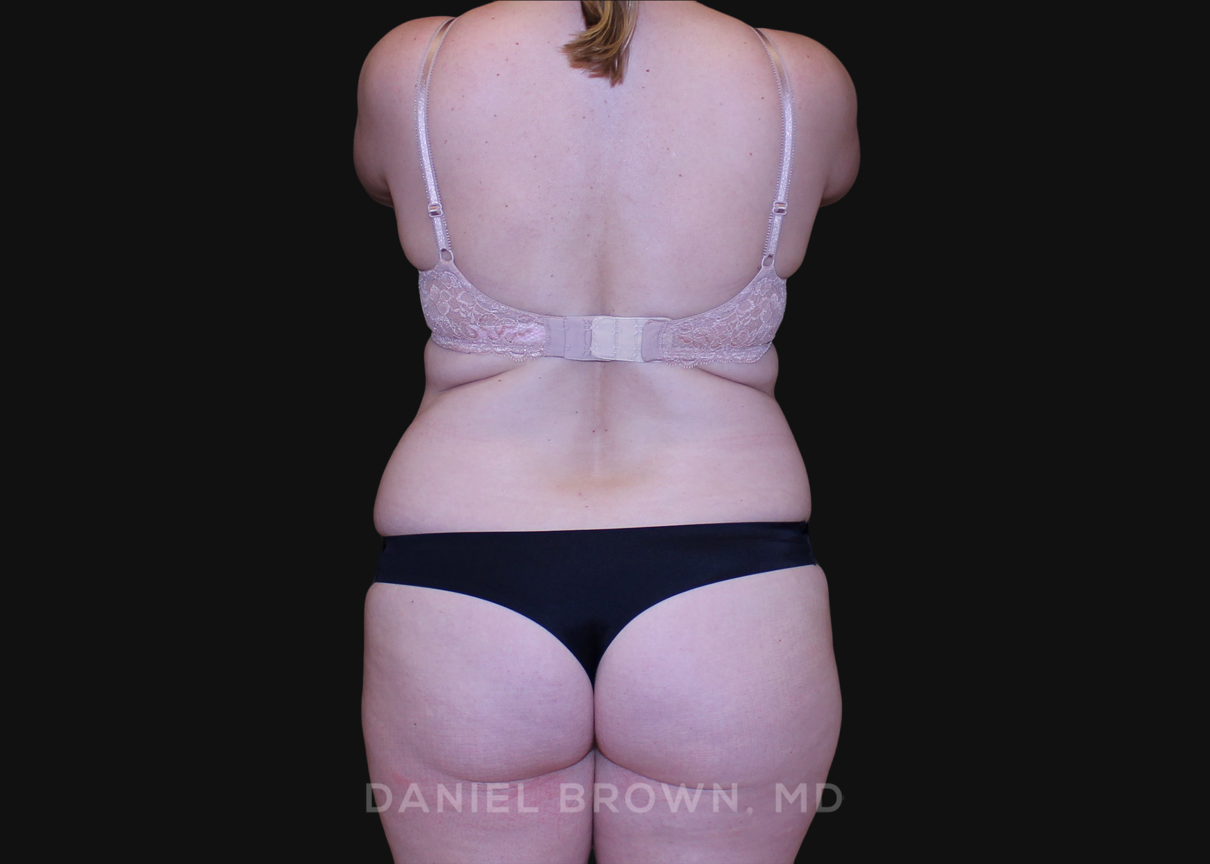 Tummy Tuck Patient Photo - Case 1278 - before view-5