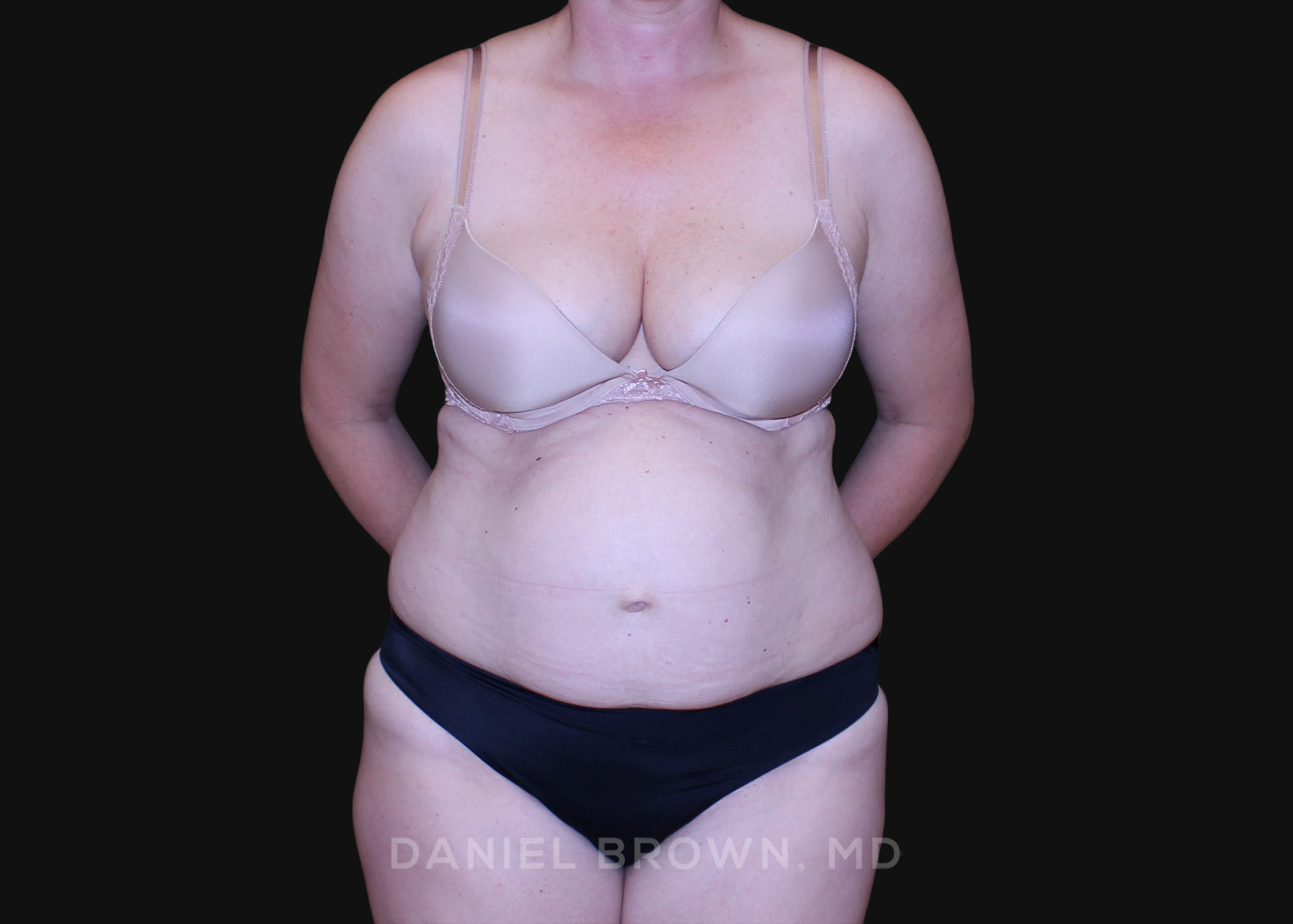 Tummy Tuck Patient Photo - Case 1278 - before view-0