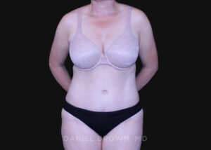 Tummy Tuck - Case 1278 - After