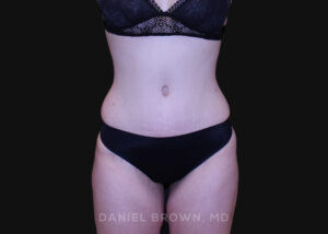 Tummy Tuck - Case 1291 - After