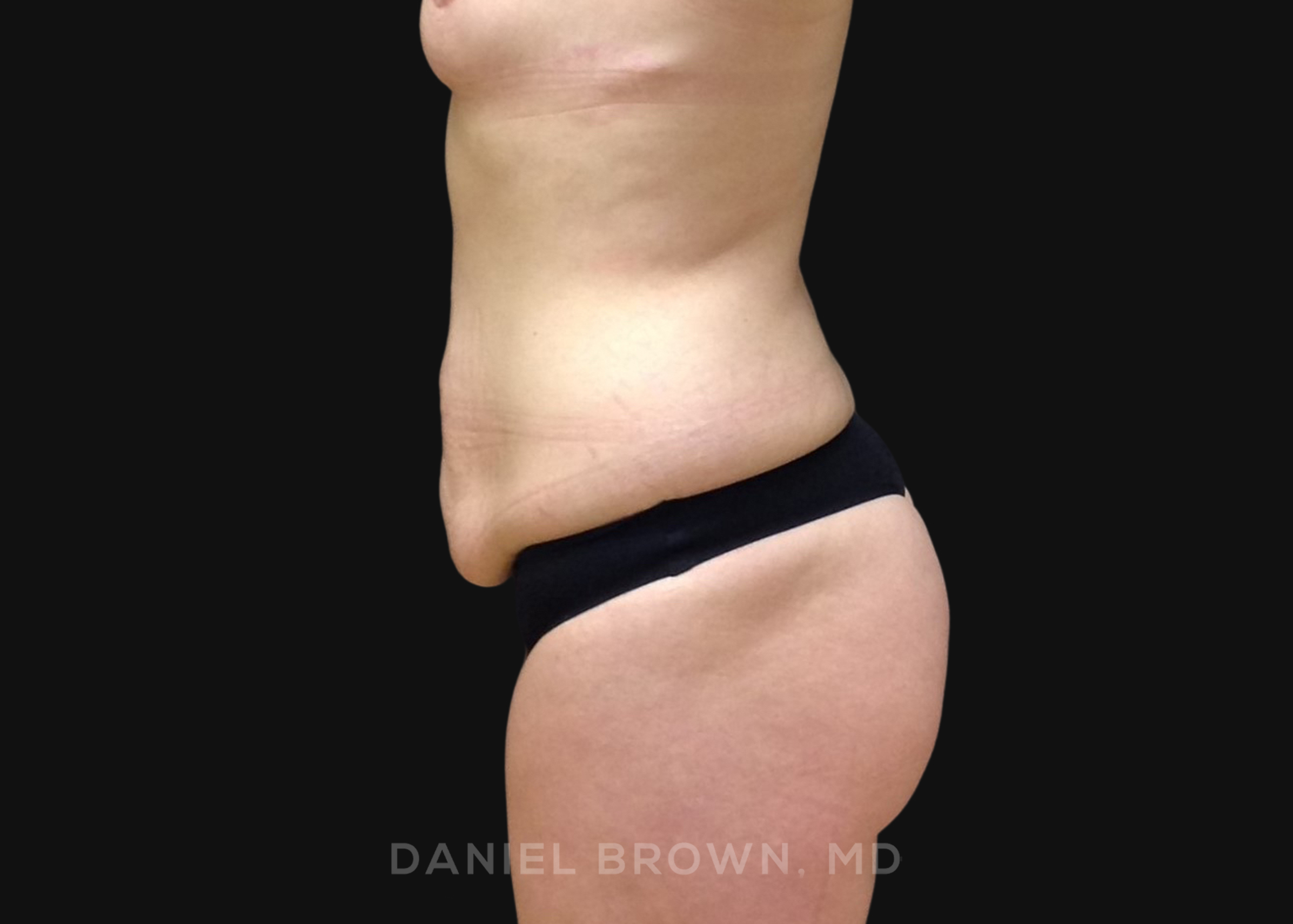 Tummy Tuck Patient Photo - Case 1291 - before view-3