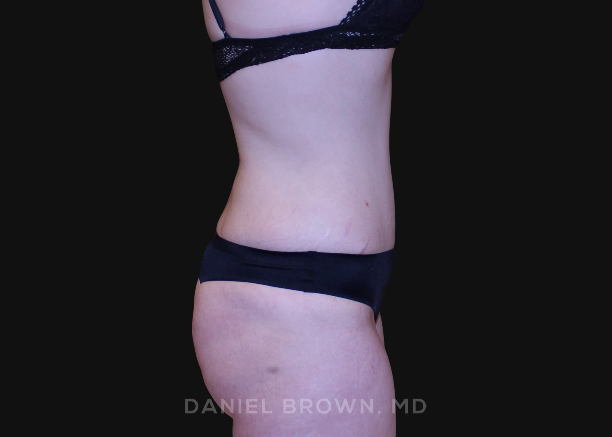 Tummy Tuck Patient Photo - Case 1291 - after view-4