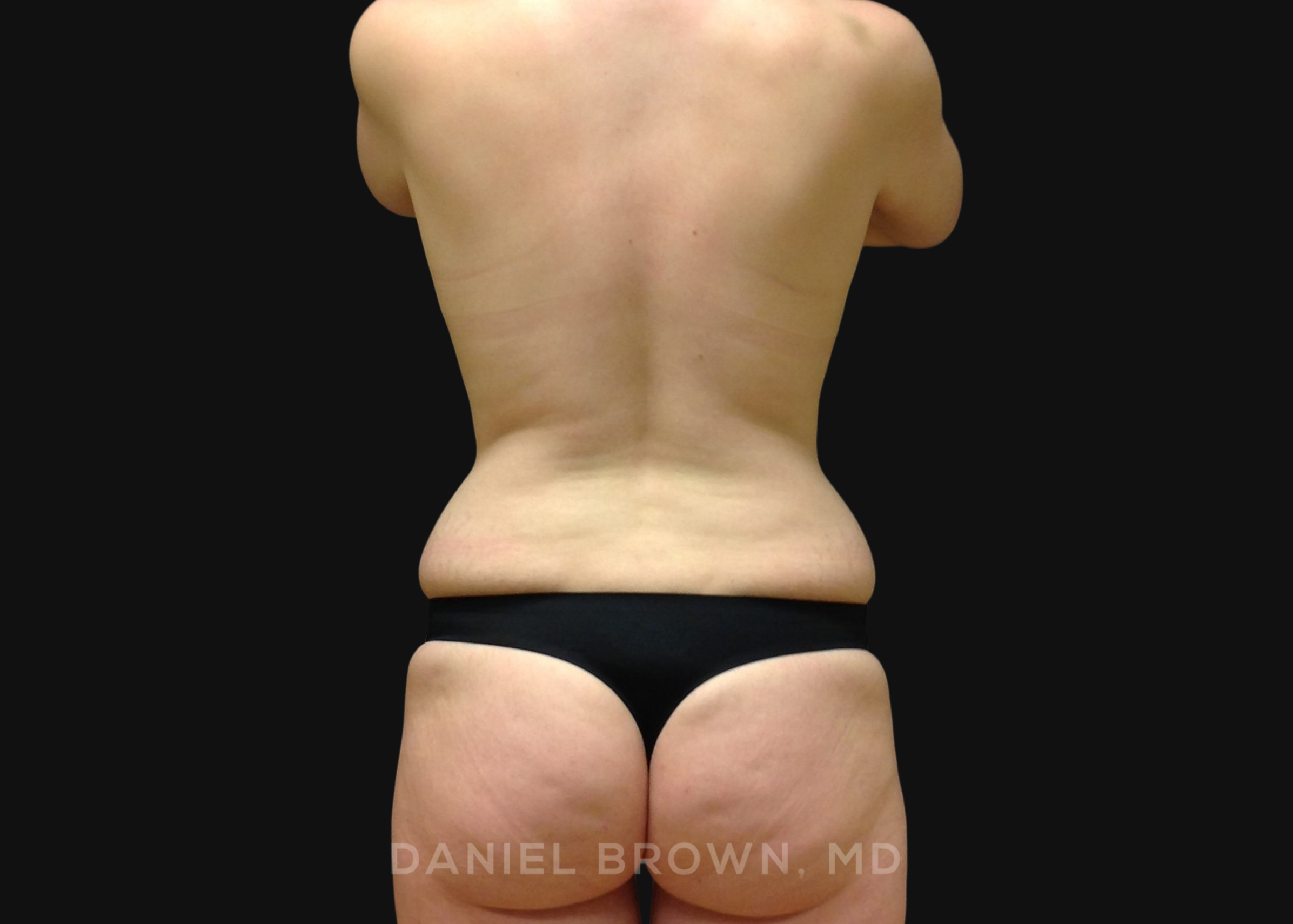 Tummy Tuck Patient Photo - Case 1291 - before view-5