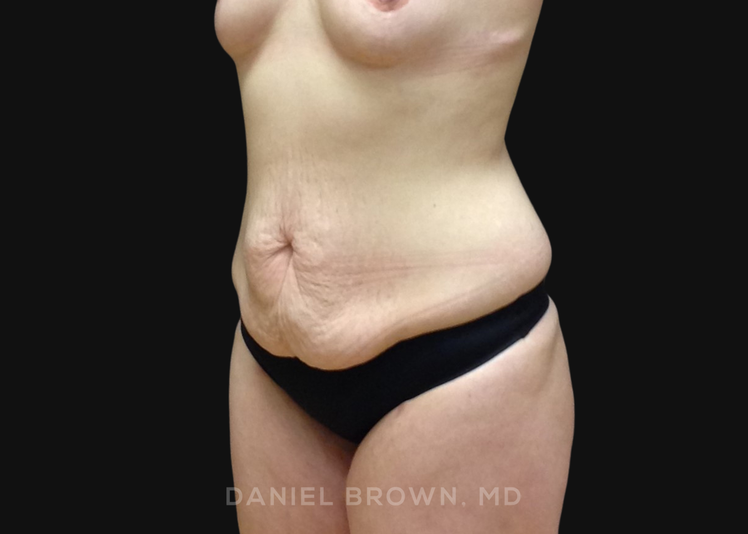 Tummy Tuck Patient Photo - Case 1291 - before view-1