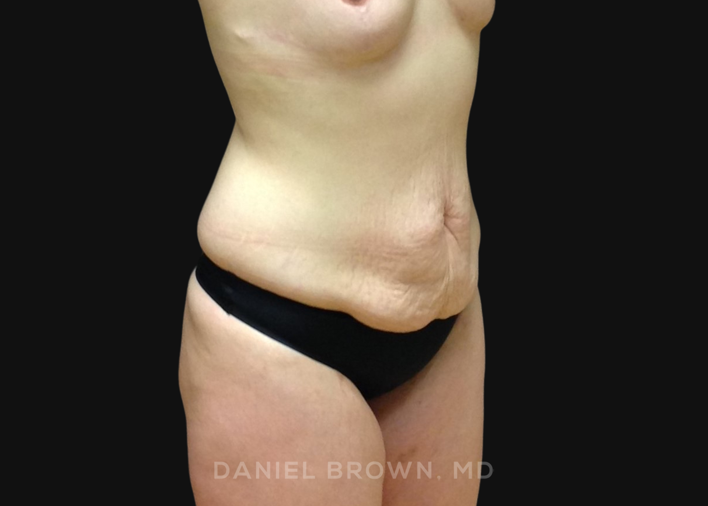 Tummy Tuck Patient Photo - Case 1291 - before view-2