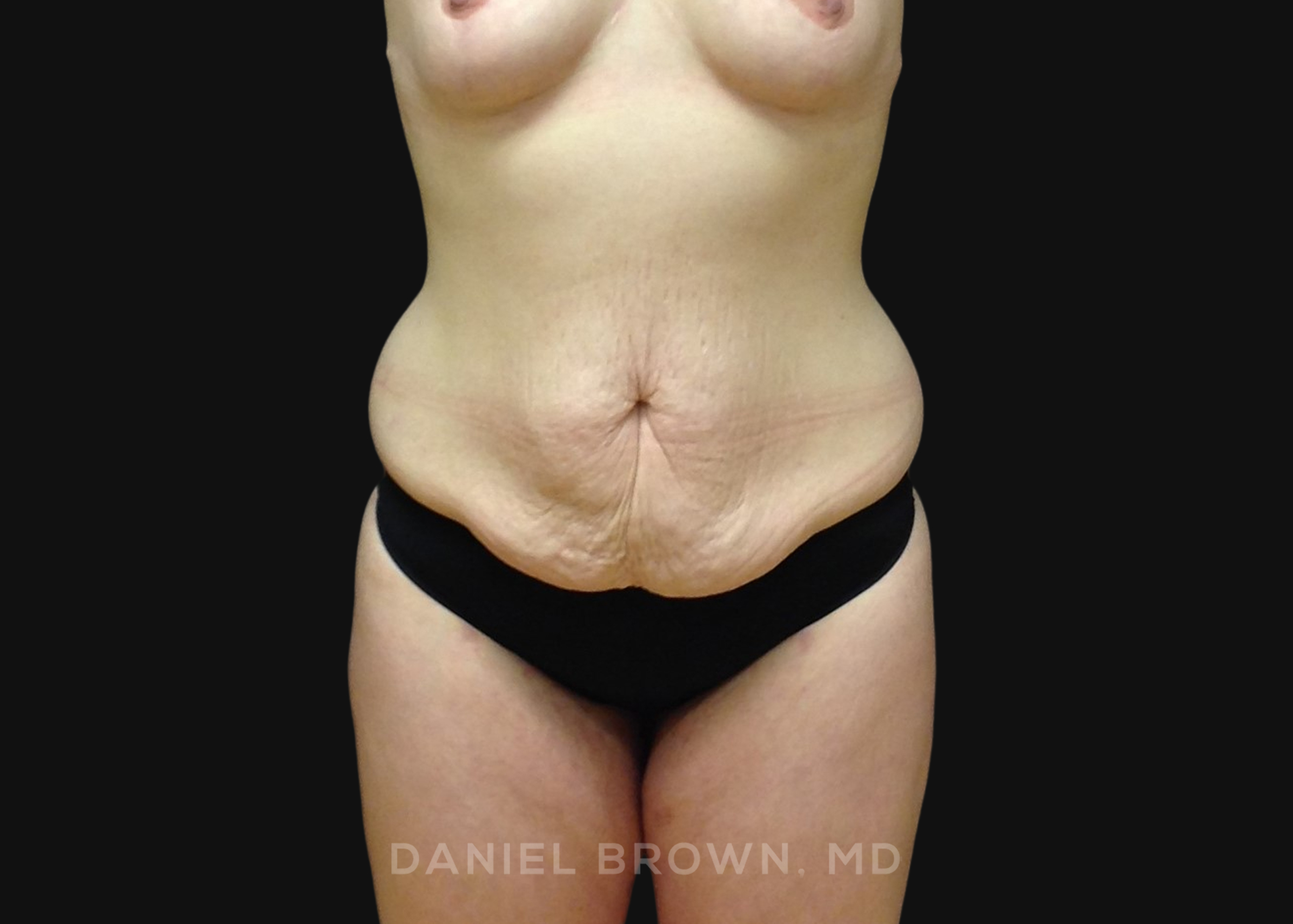 Tummy Tuck Patient Photo - Case 1291 - before view-0