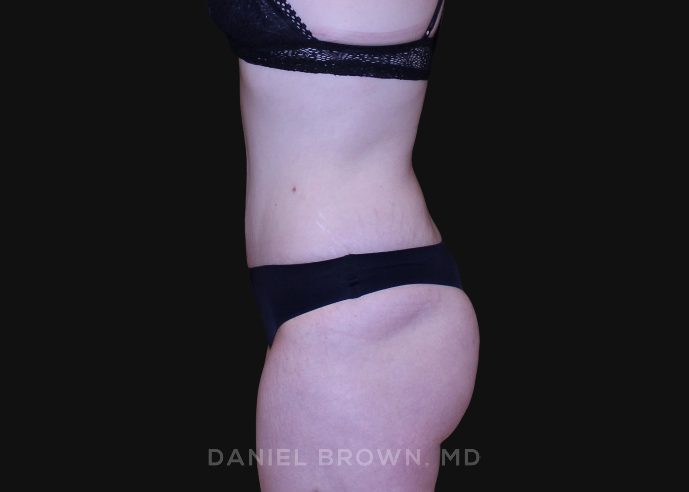 Tummy Tuck Patient Photo - Case 1291 - after view