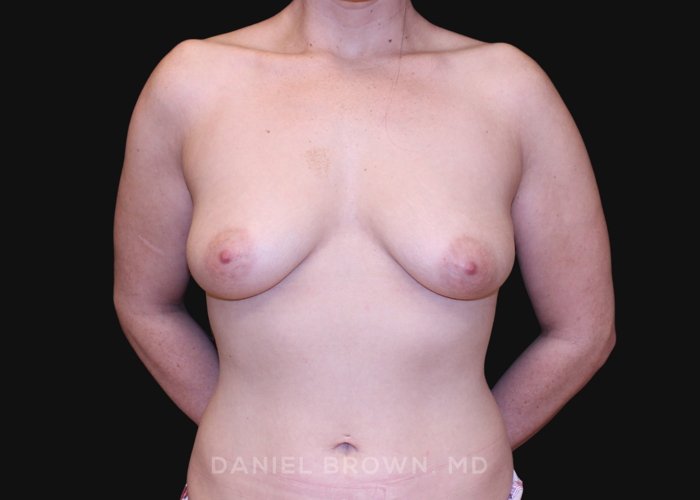 Periareolar Breast Lift/Aug Patient Photo - Case 1304 - before view-0