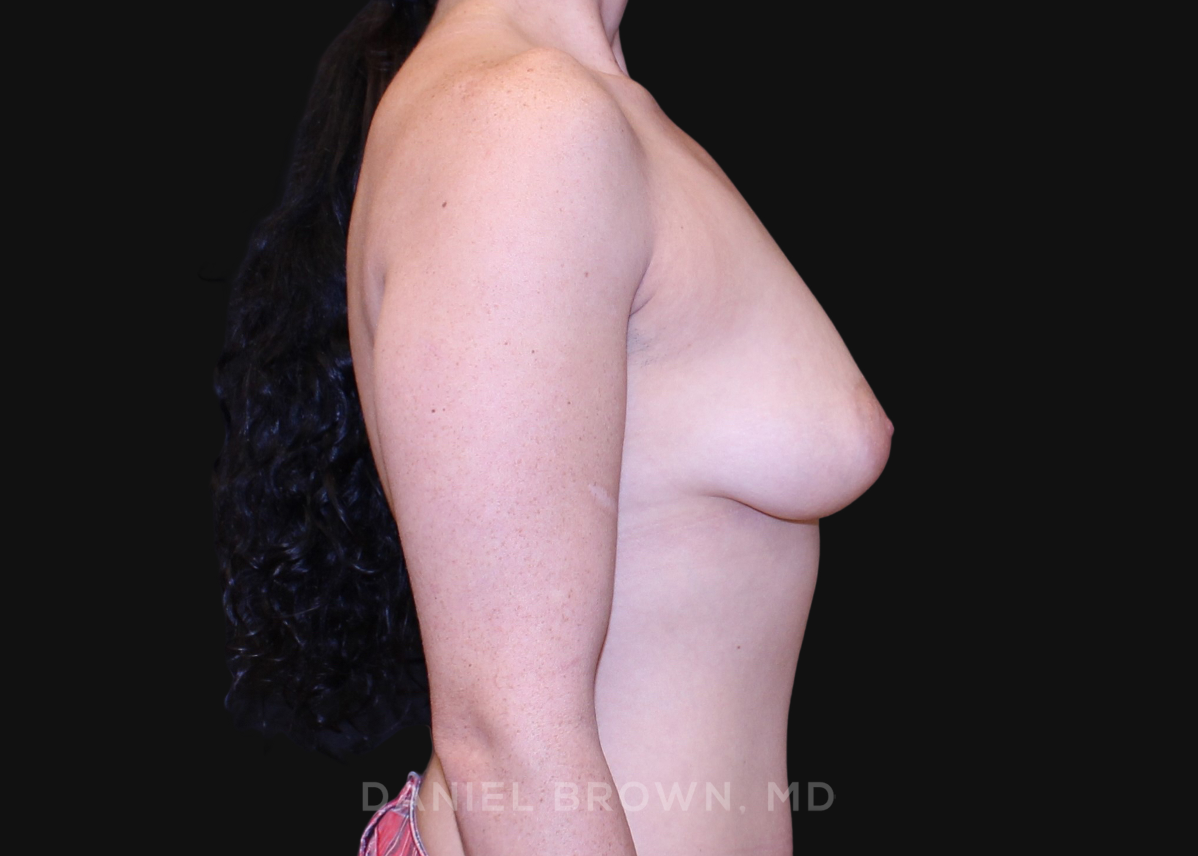Periareolar Breast Lift/Aug Patient Photo - Case 1304 - before view-4