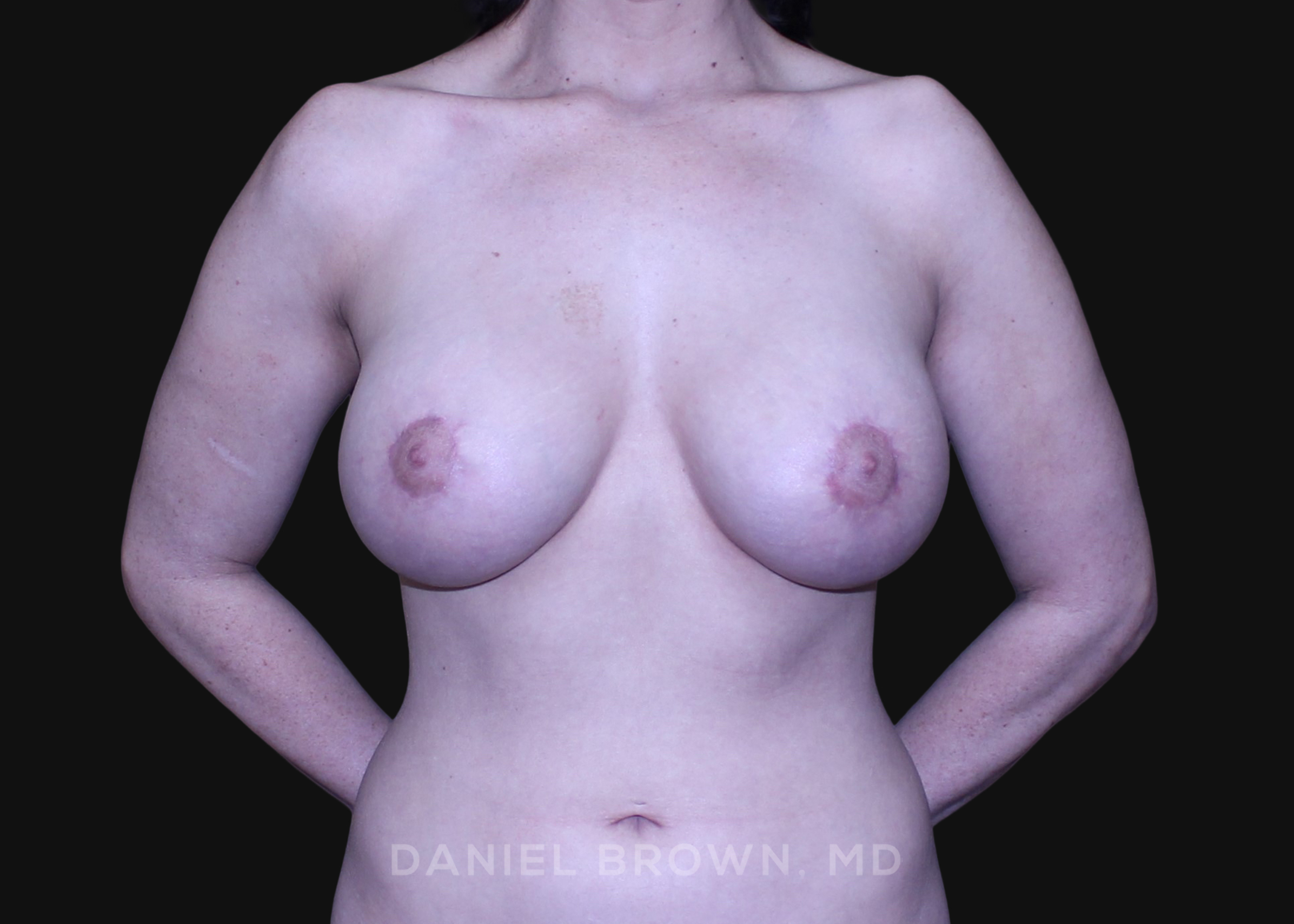 Periareolar Breast Lift/Aug Patient Photo - Case 1304 - after view-0