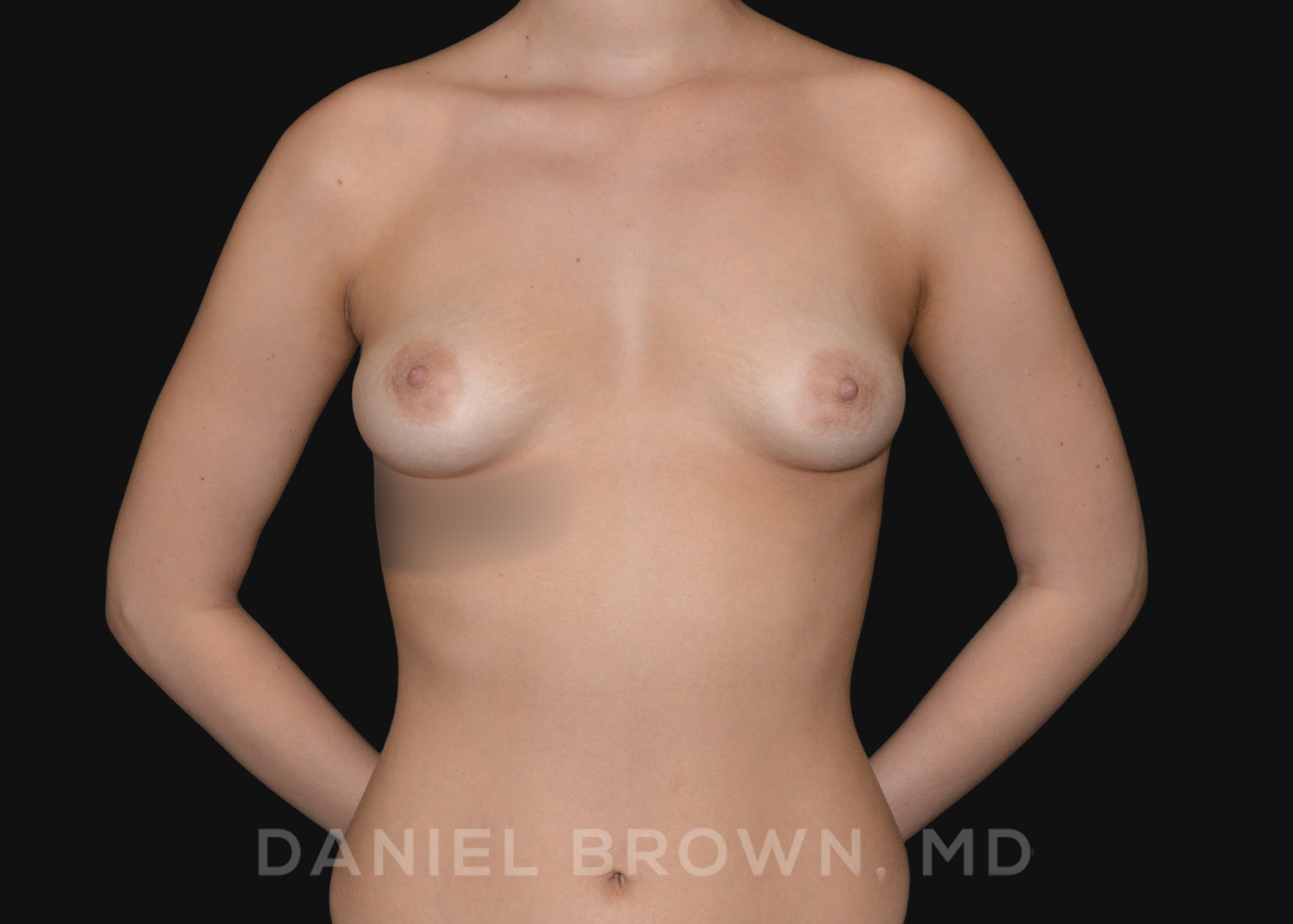 Periareolar Breast Lift/Aug Patient Photo - Case 1315 - before view-0