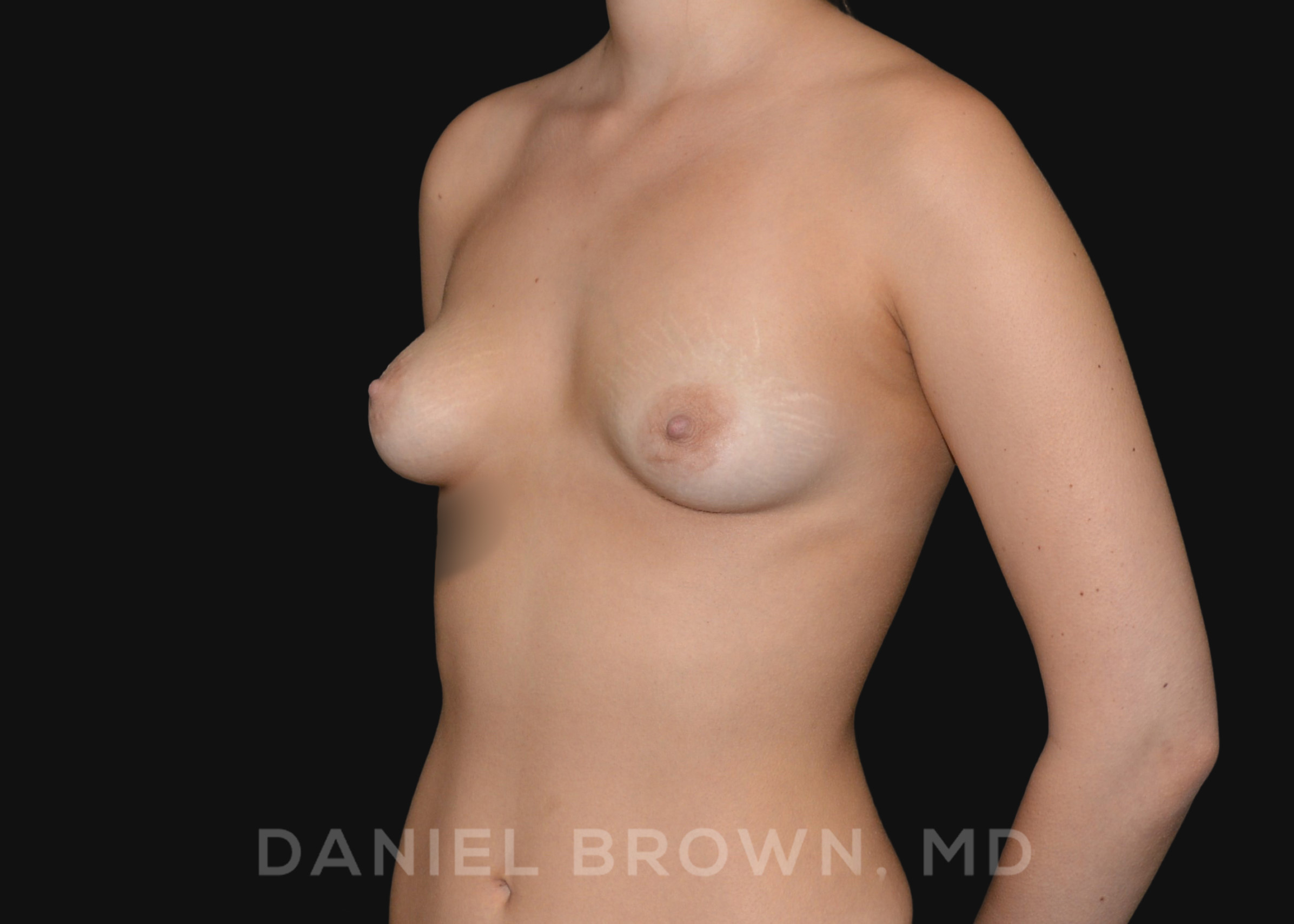 Periareolar Breast Lift/Aug Patient Photo - Case 1315 - before view-1