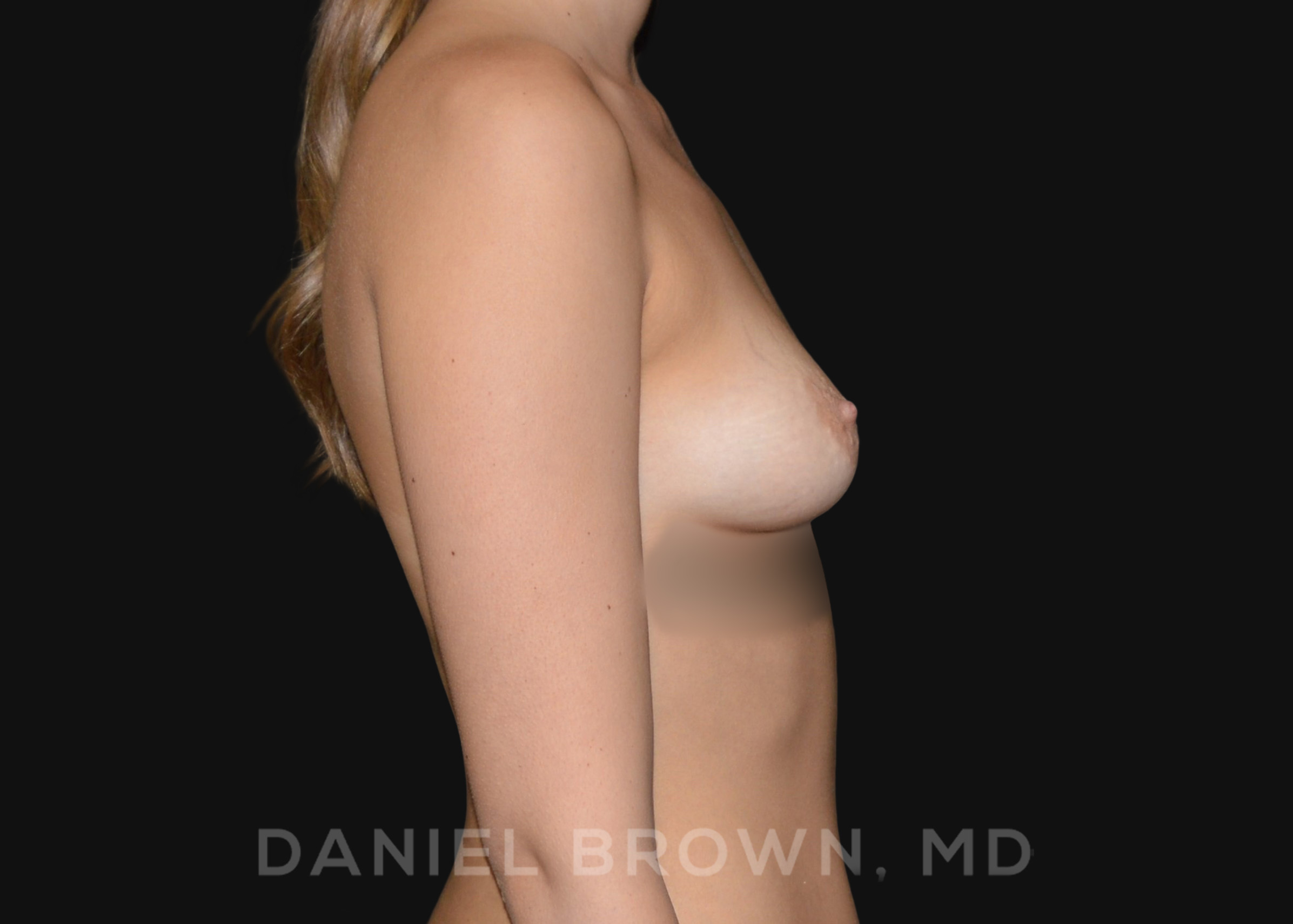Periareolar Breast Lift/Aug Patient Photo - Case 1315 - before view-4