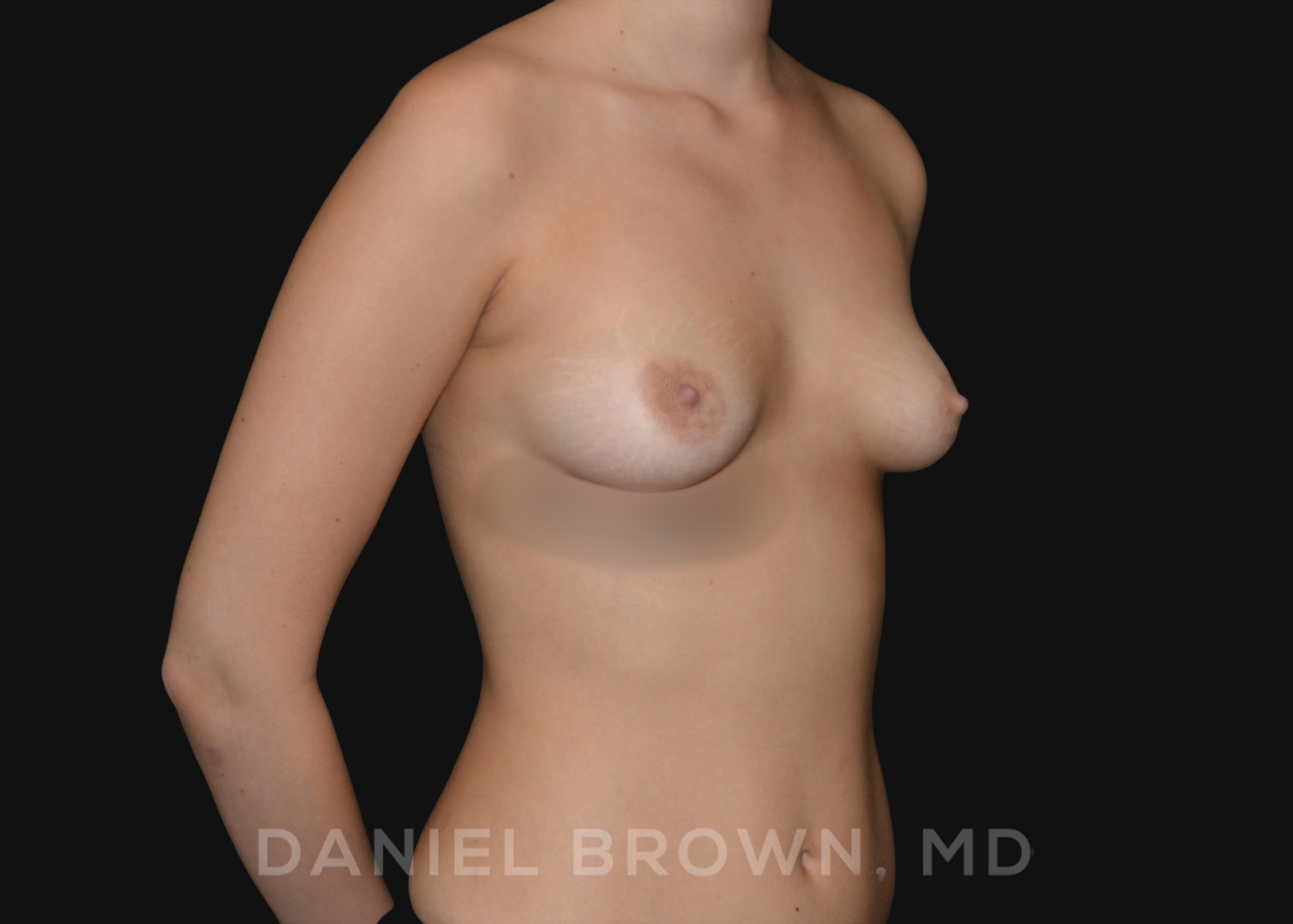 Periareolar Breast Lift/Aug Patient Photo - Case 1315 - before view-2