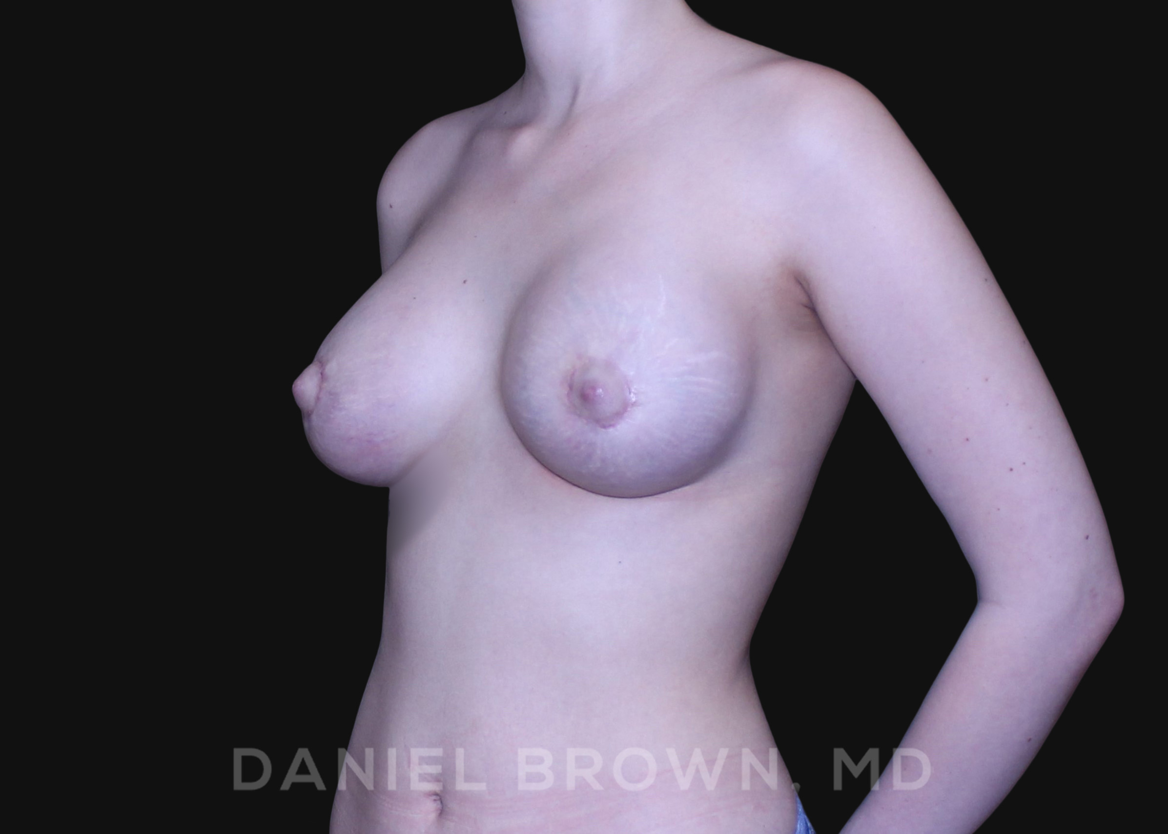 Periareolar Breast Lift/Aug Patient Photo - Case 1315 - after view-1