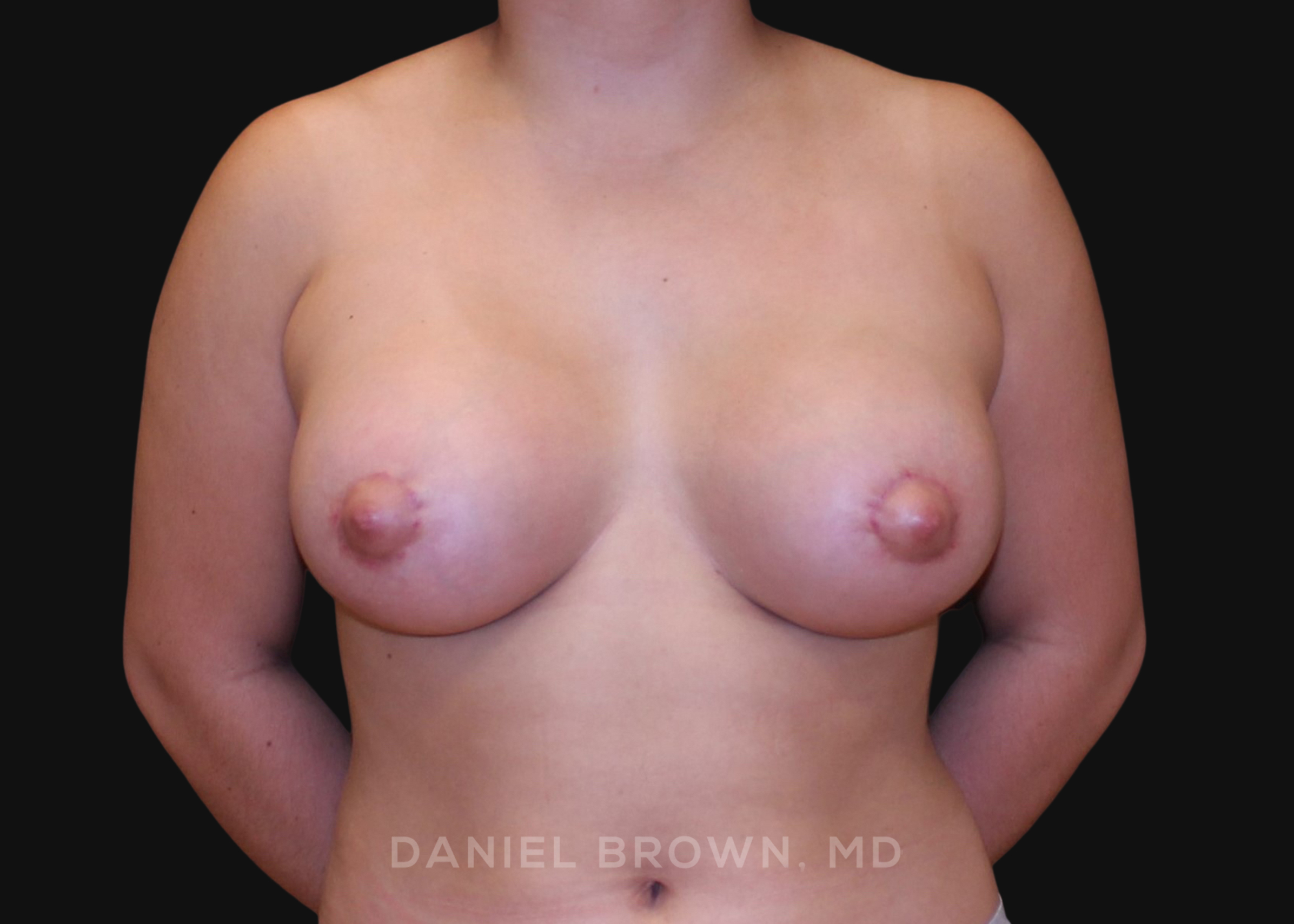 Periareolar Breast Lift/Aug Patient Photo - Case 1326 - after view
